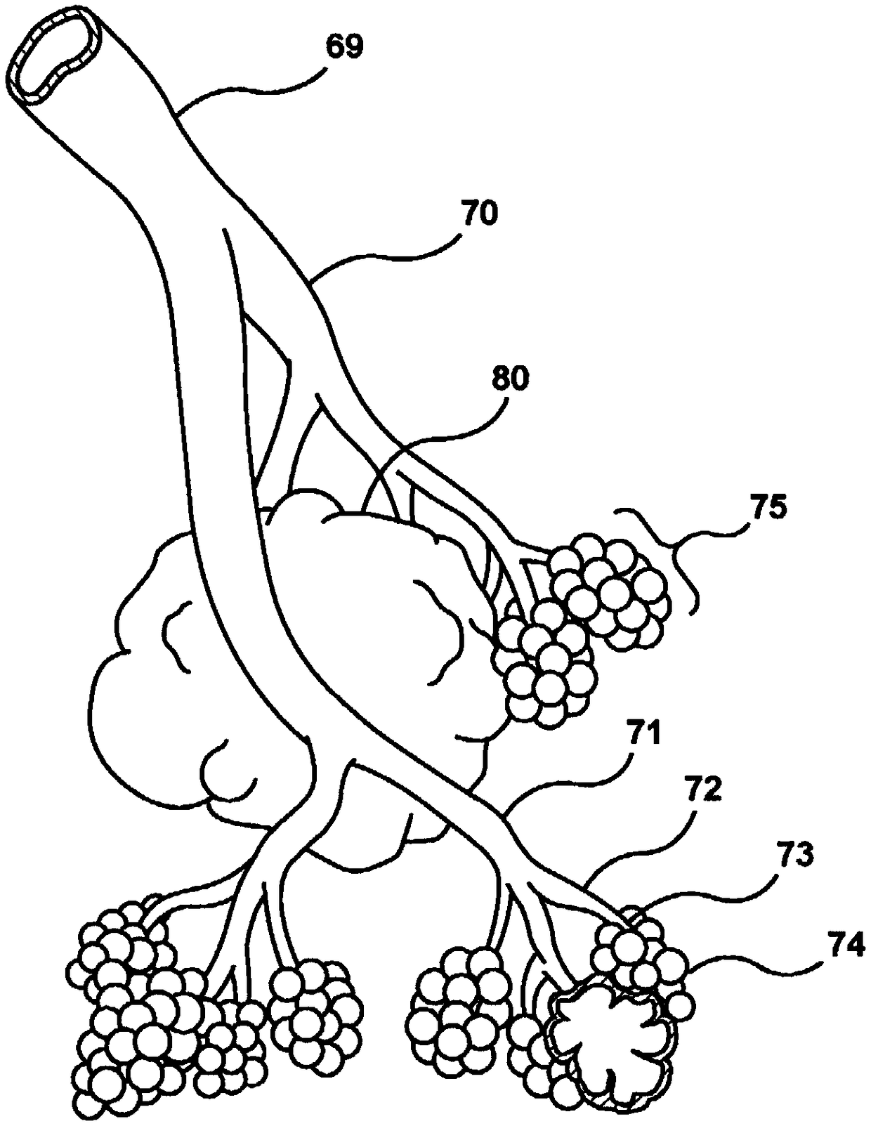 Devices and methods for treating lung tumors