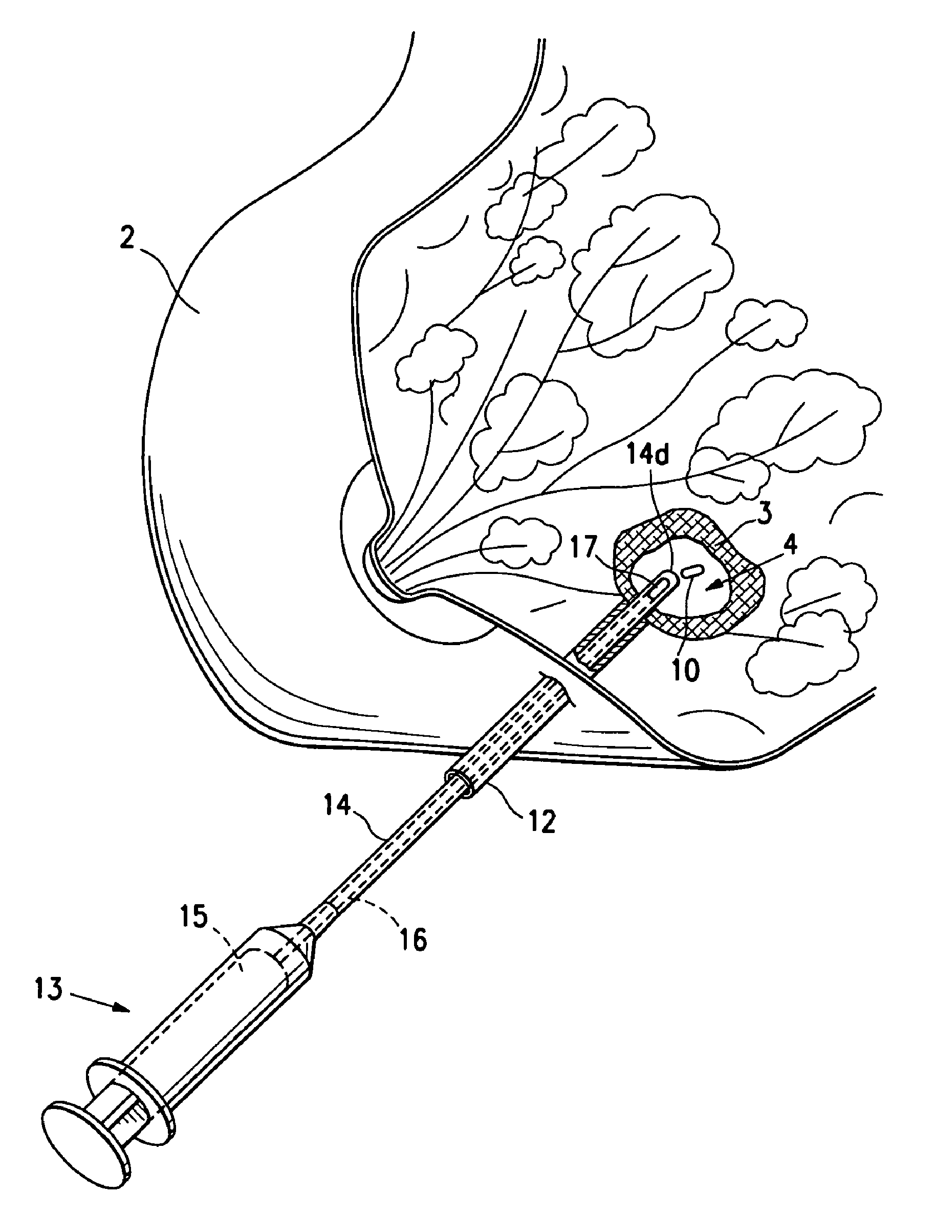 Tissue site markers for in vivo imaging