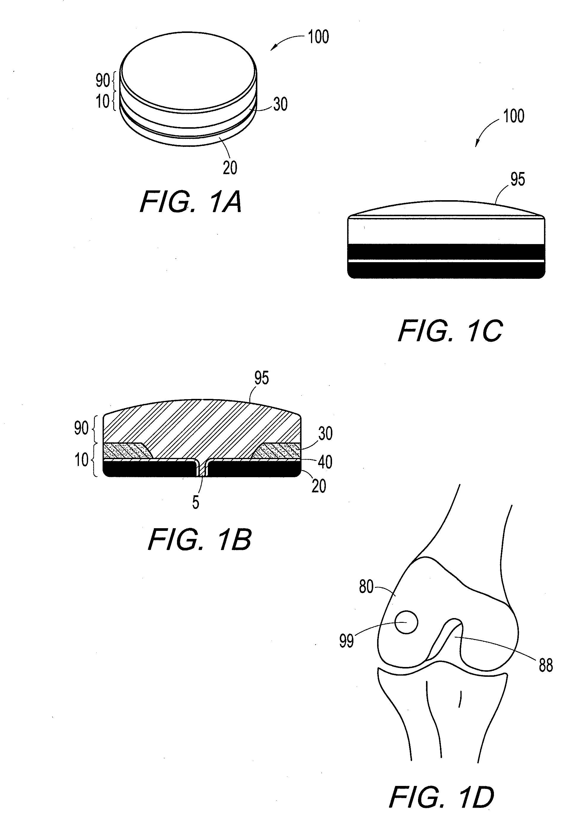 Hybrid polymer/metal plug for treating chondral defects