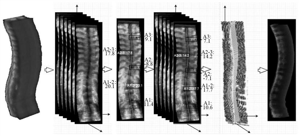 A Sagittal Plane Projection Imaging Method Based on 3D Ultrasound Spine Data