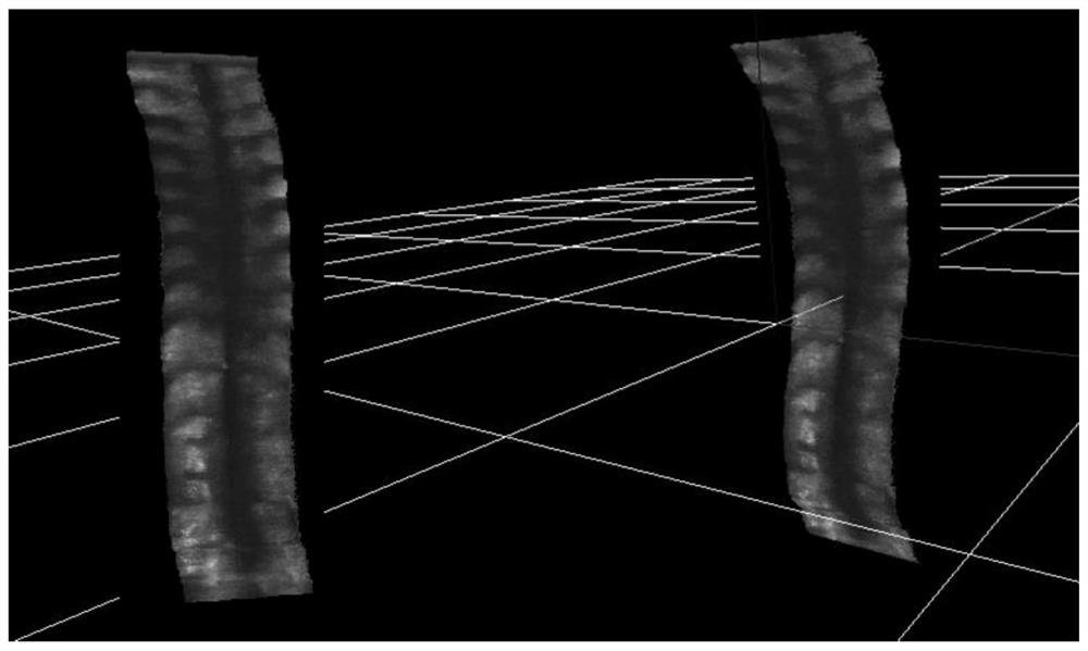 A Sagittal Plane Projection Imaging Method Based on 3D Ultrasound Spine Data