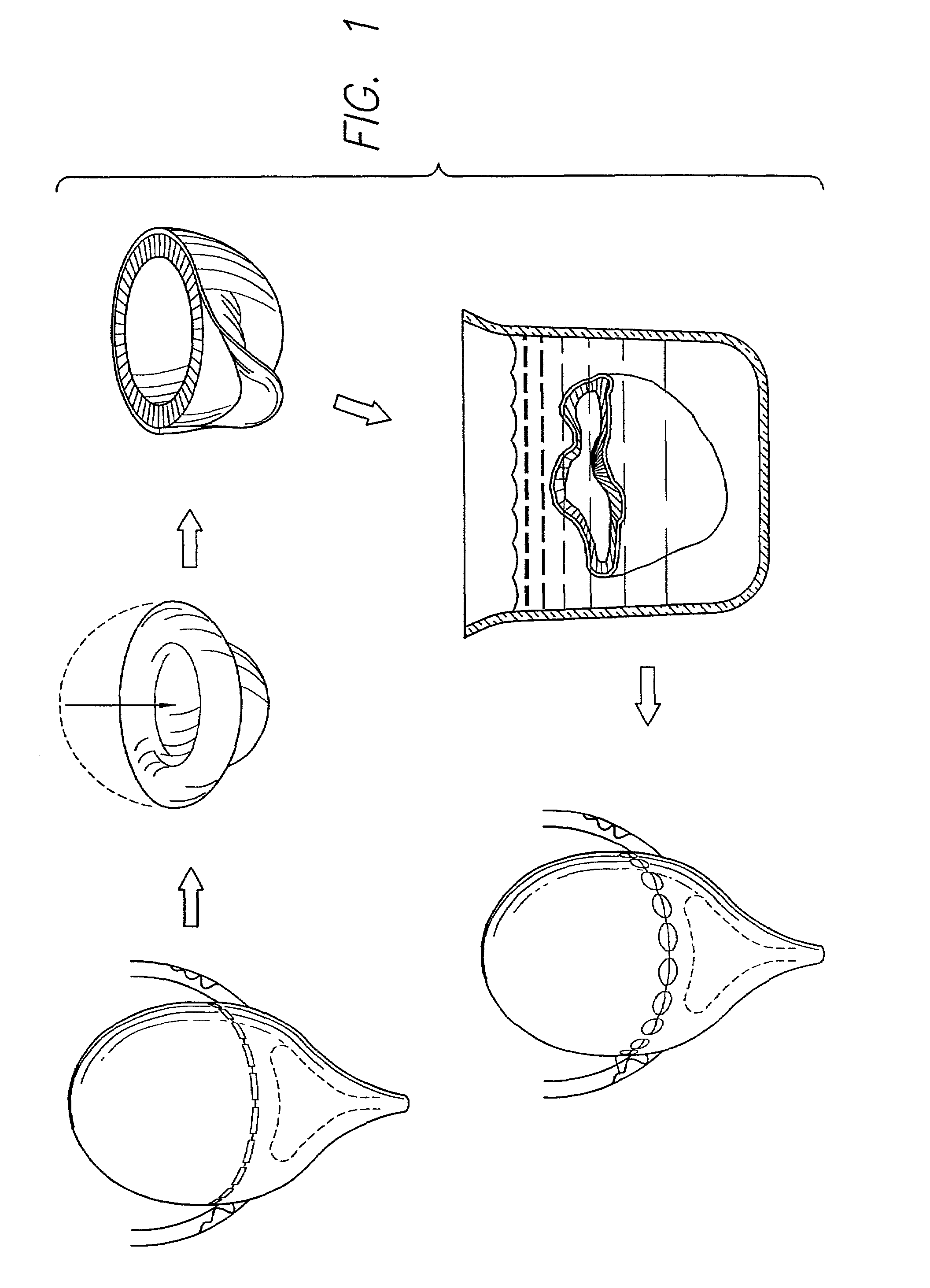 Acellular matrix grafts of collagen and elastic fiber