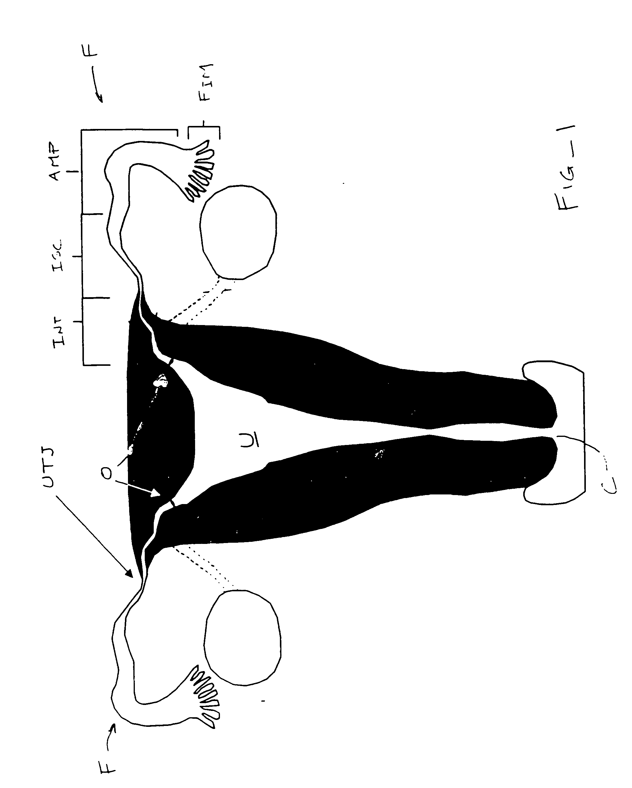 Catheter for intrafallopian contraceptive delivery