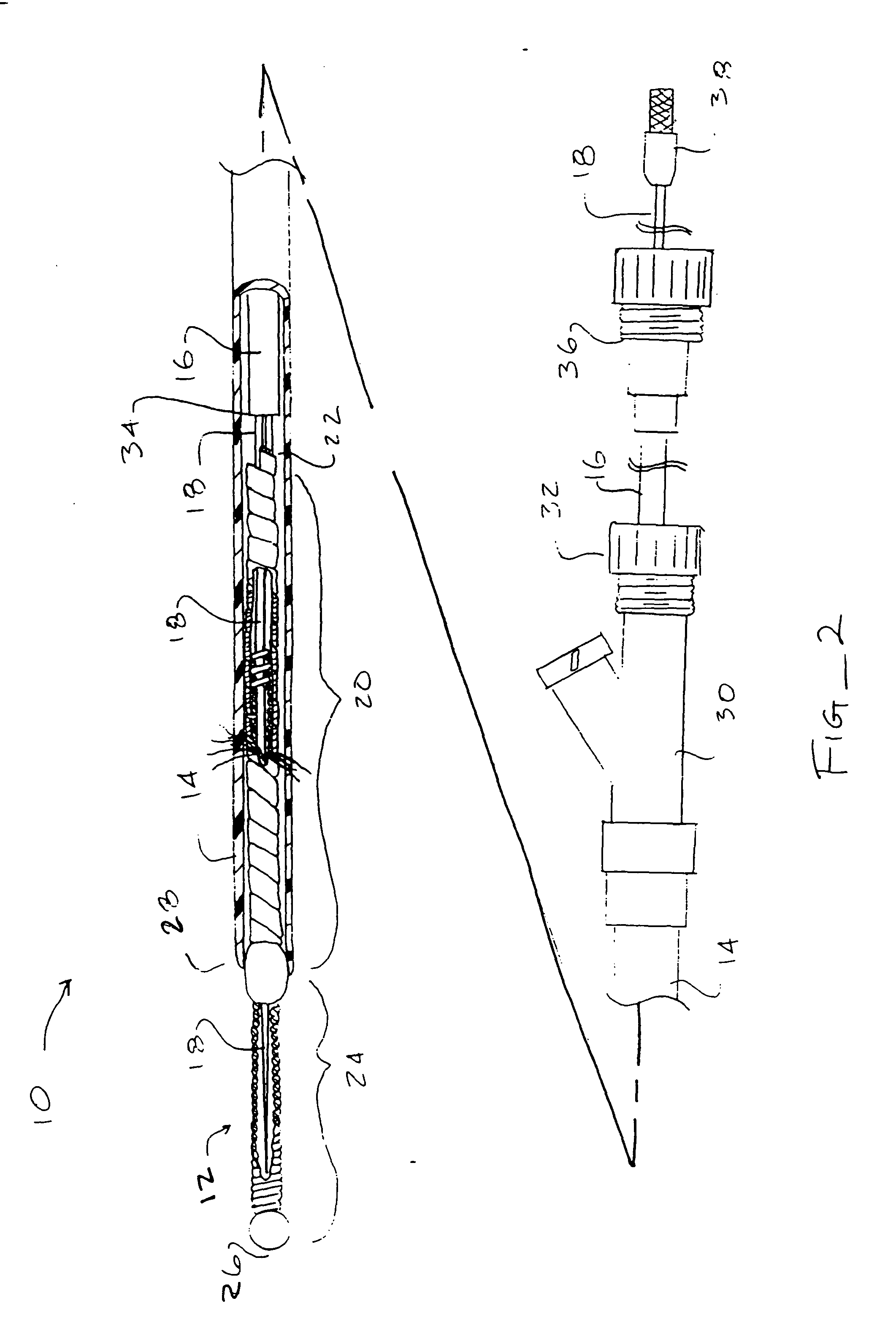 Catheter for intrafallopian contraceptive delivery