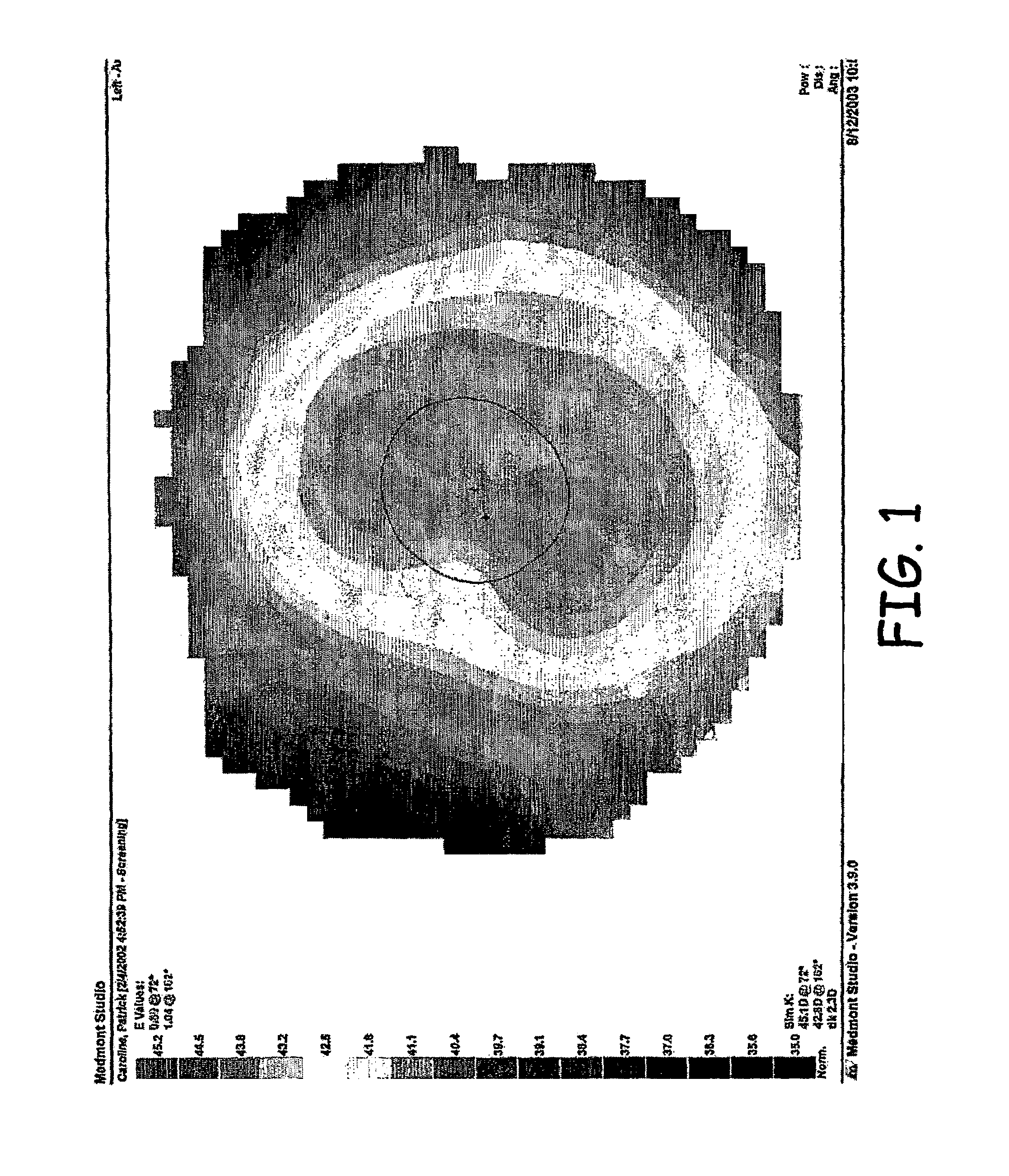 Soft lens orthokeratology