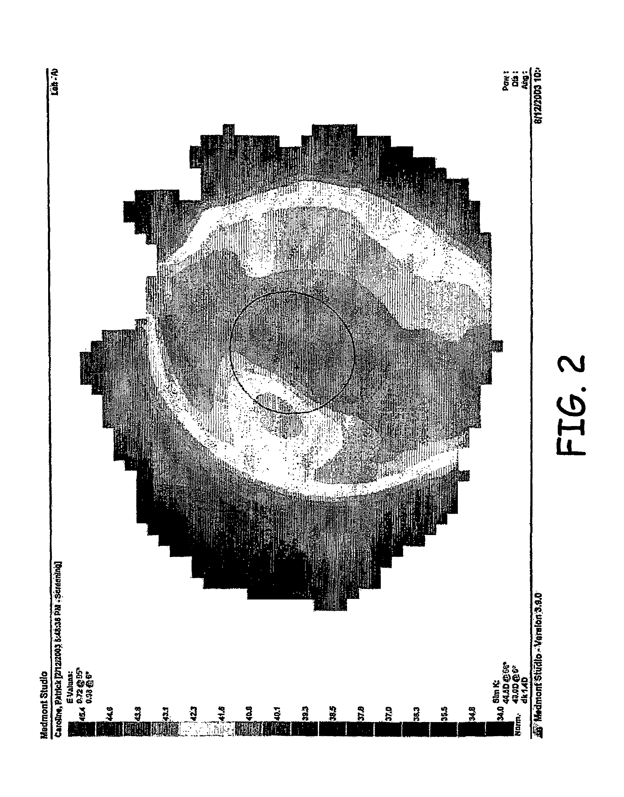 Soft lens orthokeratology