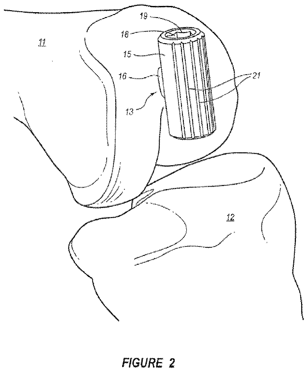 Arthroplasty systems and methods for optimally aligning and tensioning a knee prosthesis