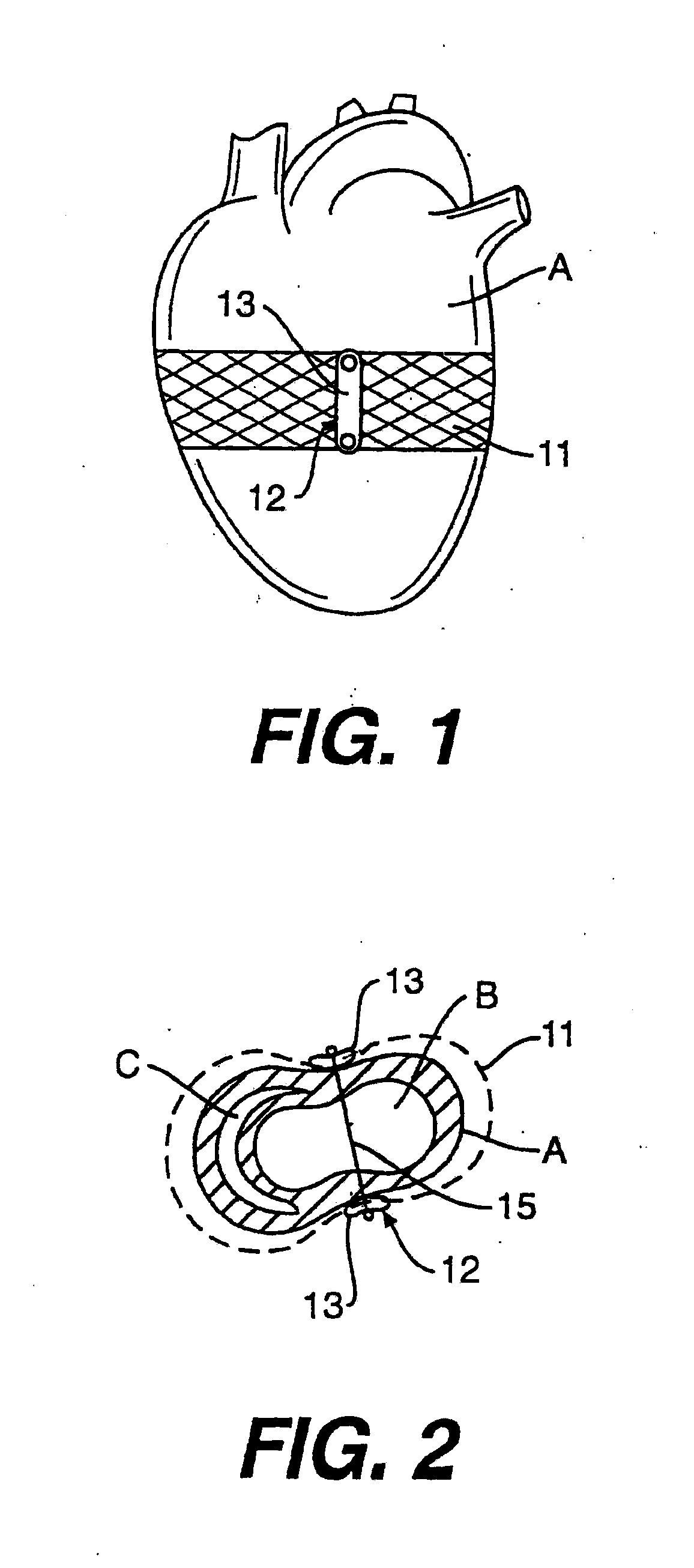 Heart Wall Tension Reduction Apparatus and Method