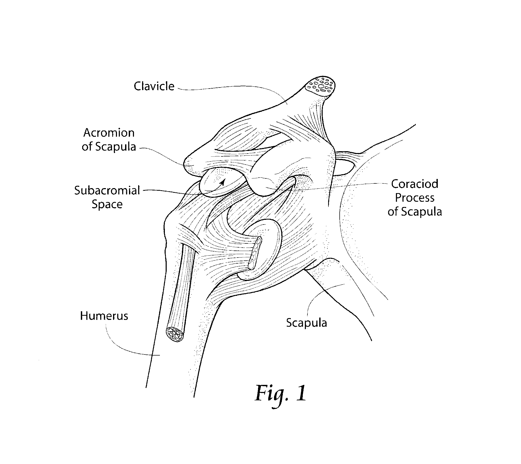 System and method for treating shoulder pain related to subacromial impingement syndrome