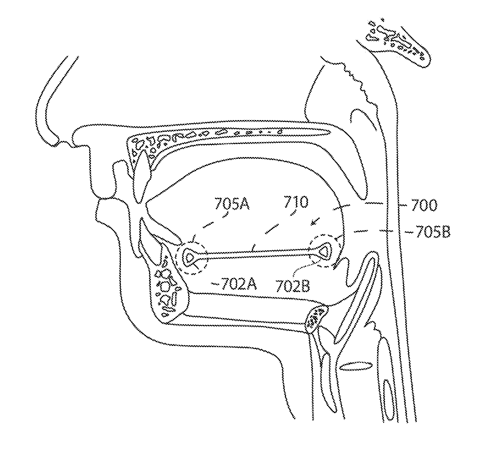 Systems and methods for treatment of sleep apnea