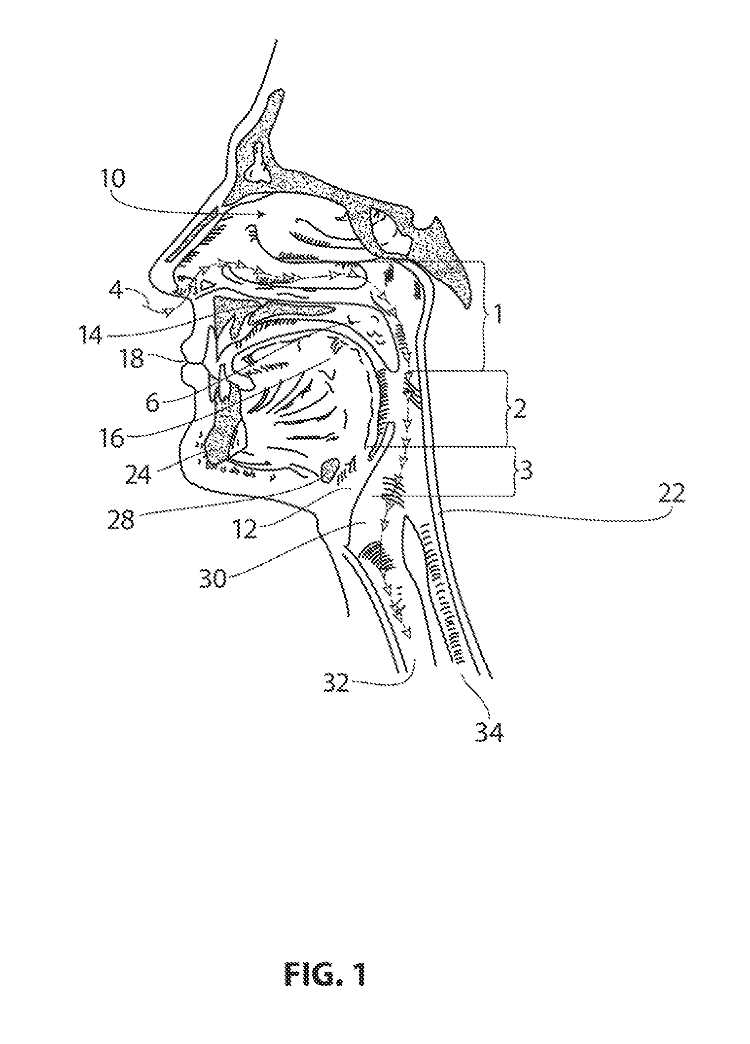 Systems and methods for treatment of sleep apnea