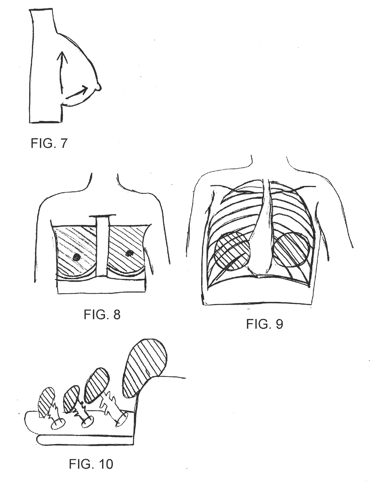 Pyramid-shaped breast implant for breast augmentation and/or breast lift with a method of use and production of the same