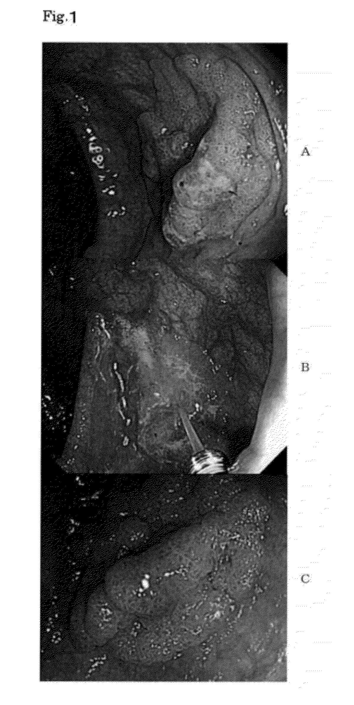 Specimen for detecting infiltrative large intestine tumors