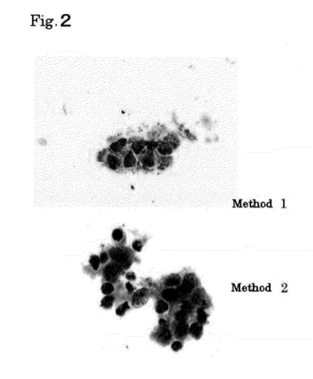 Specimen for detecting infiltrative large intestine tumors