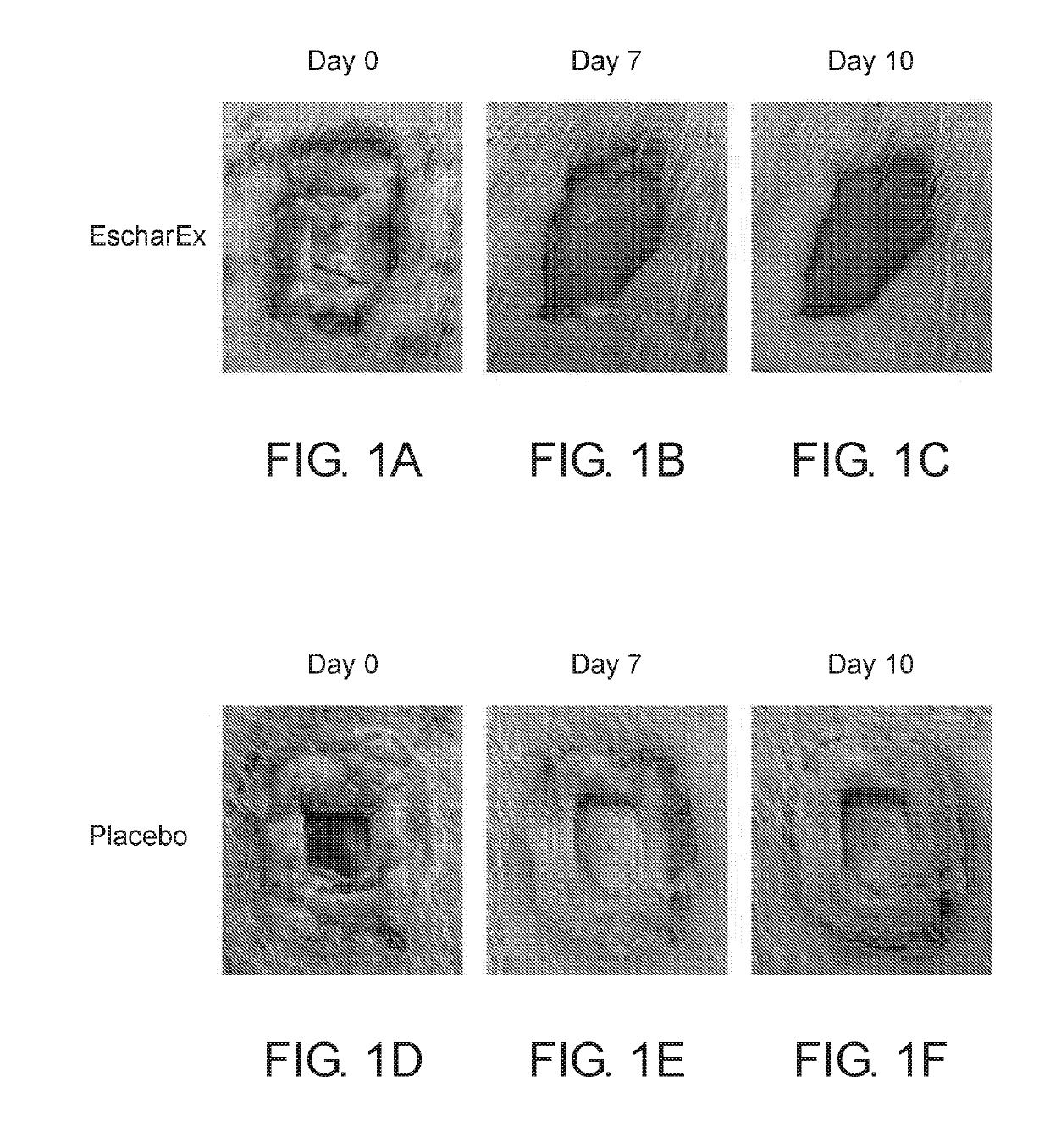 Methods of debridement of chronic wounds