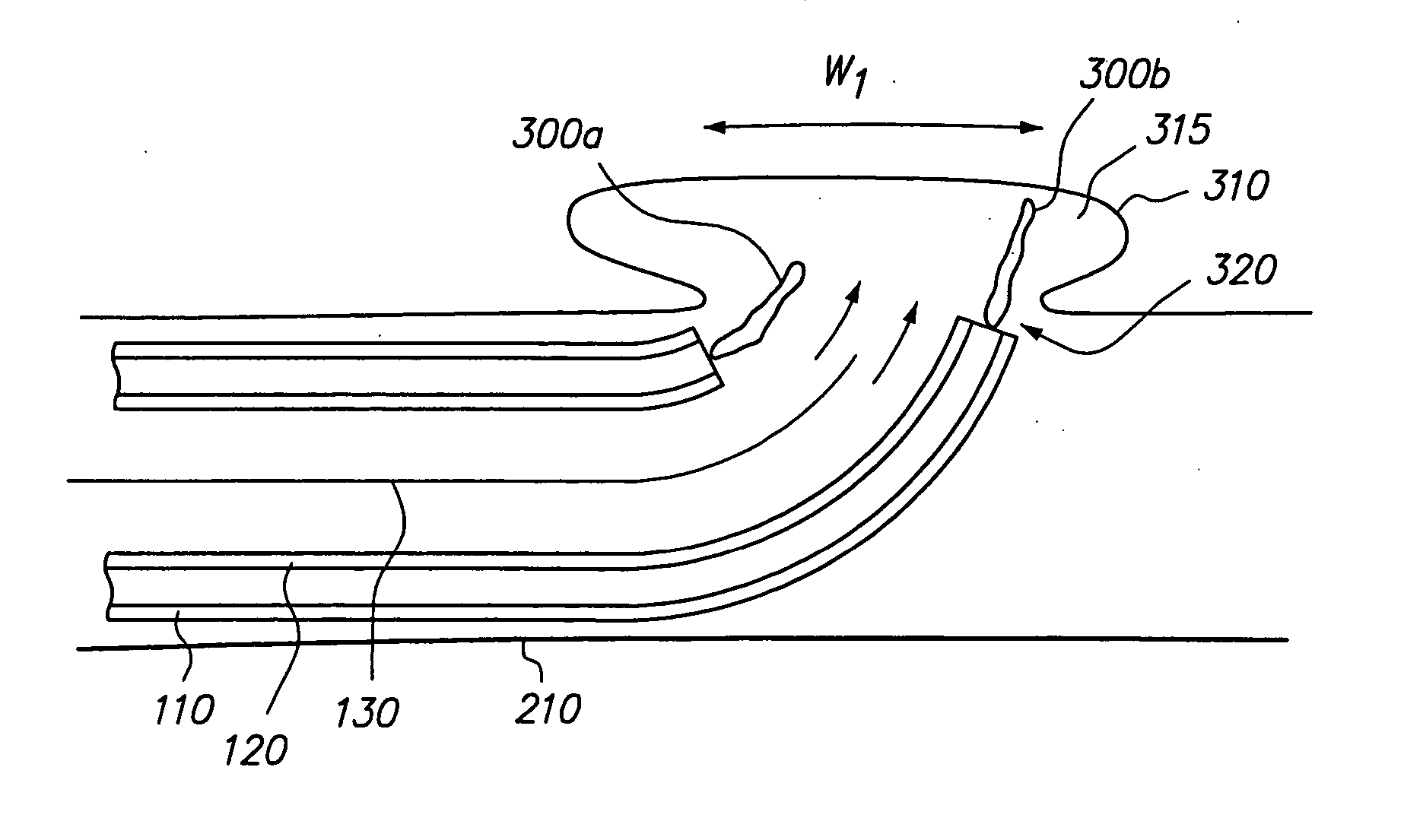 Method and system for delivering an implant utilizing a lumen reducing member