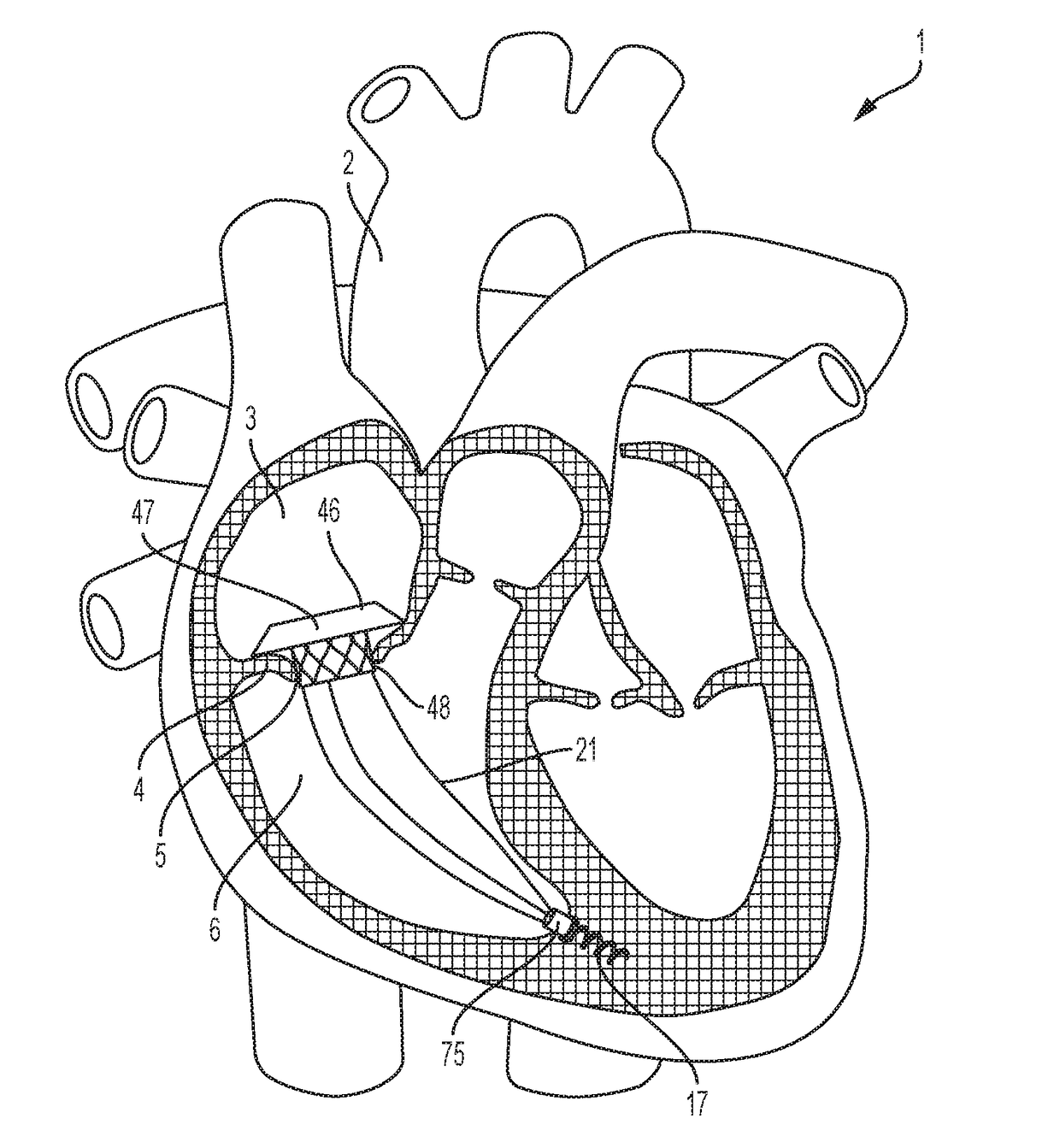 Transcatheter atrial sealing skirt, anchor, and tether and methods of implantation