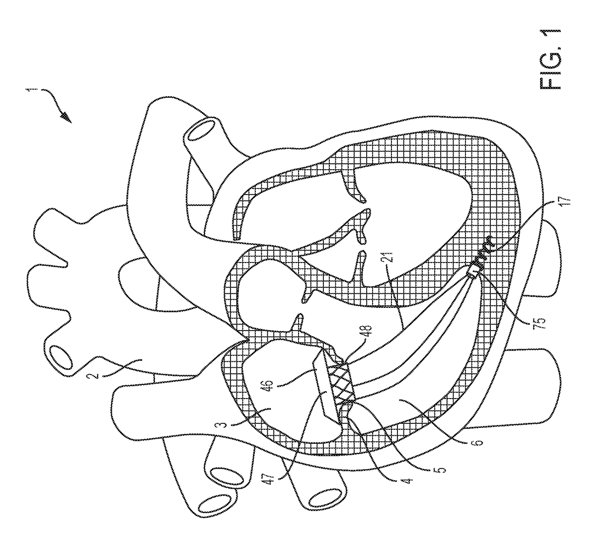 Transcatheter atrial sealing skirt, anchor, and tether and methods of implantation