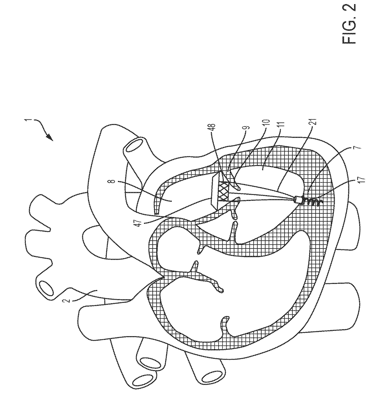 Transcatheter atrial sealing skirt, anchor, and tether and methods of implantation