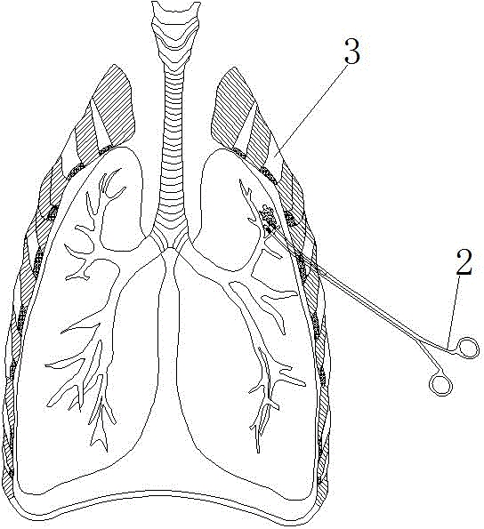 Cruising locator for pulmonary minimal focuses under thoracoscope