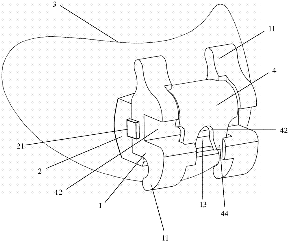 A personalized lingual straight wire arch self-locking bracket appliance