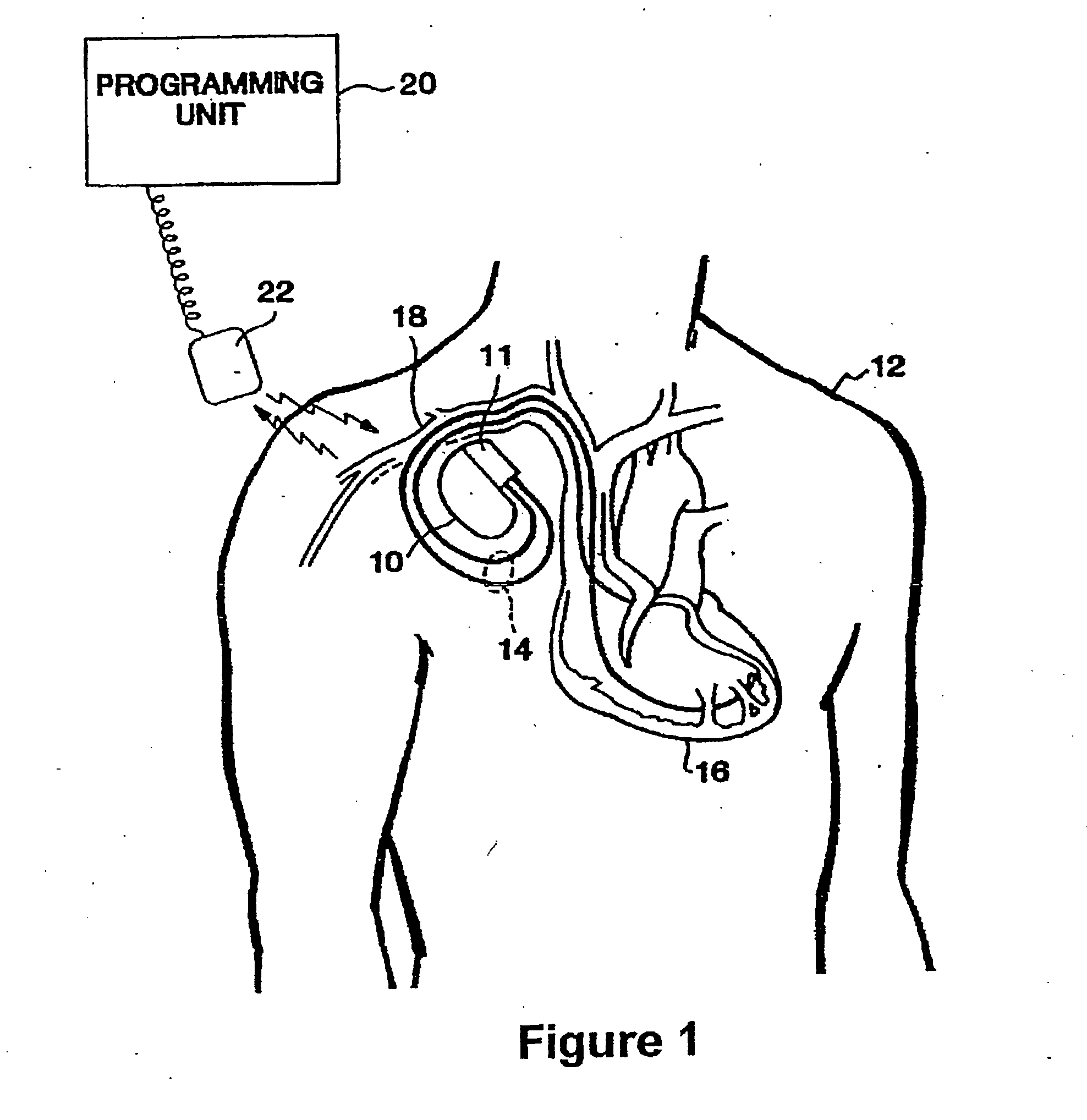 Implantable capacitive pressure sensor system and method