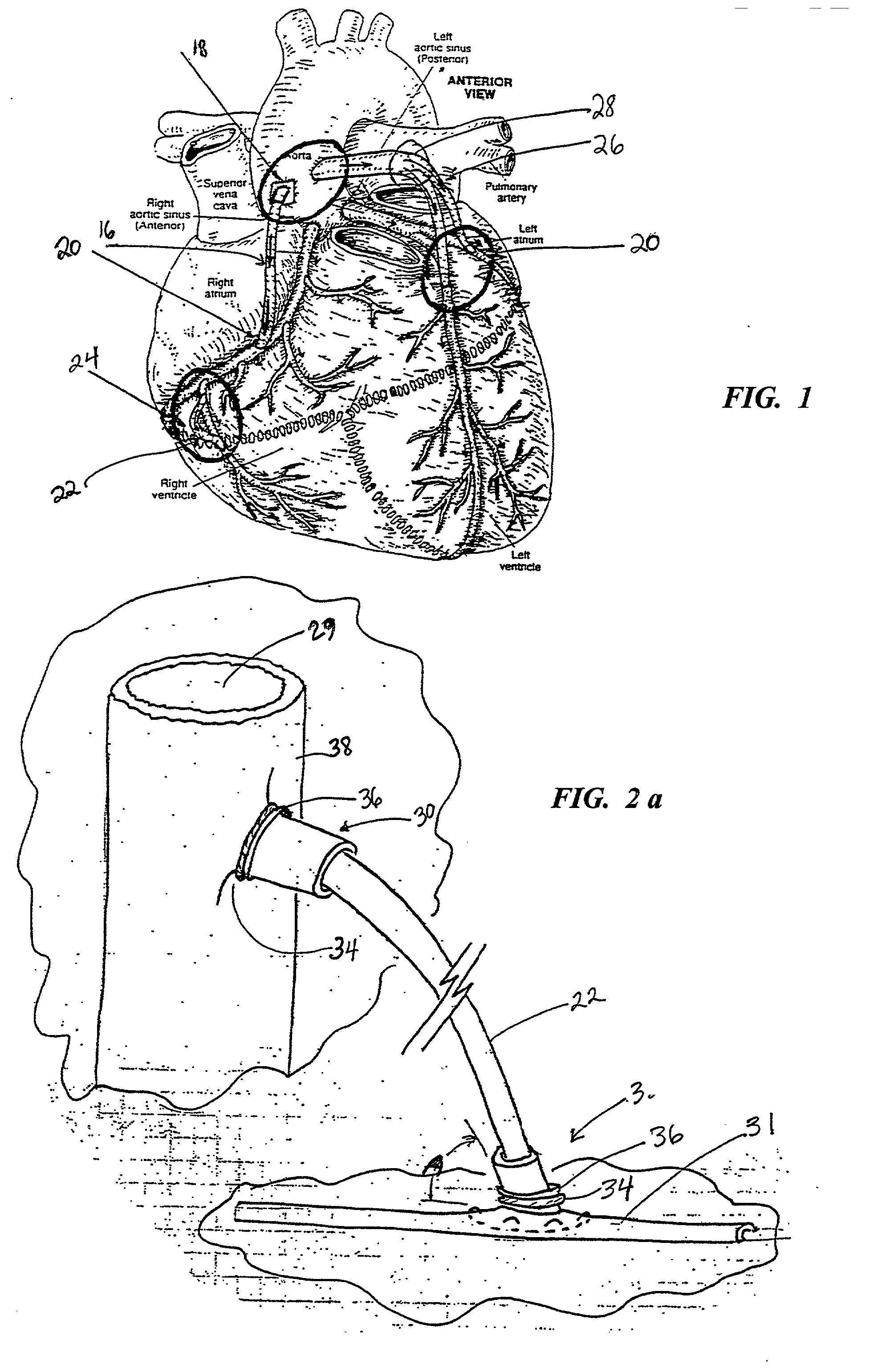 Sutureless anastomosis systems