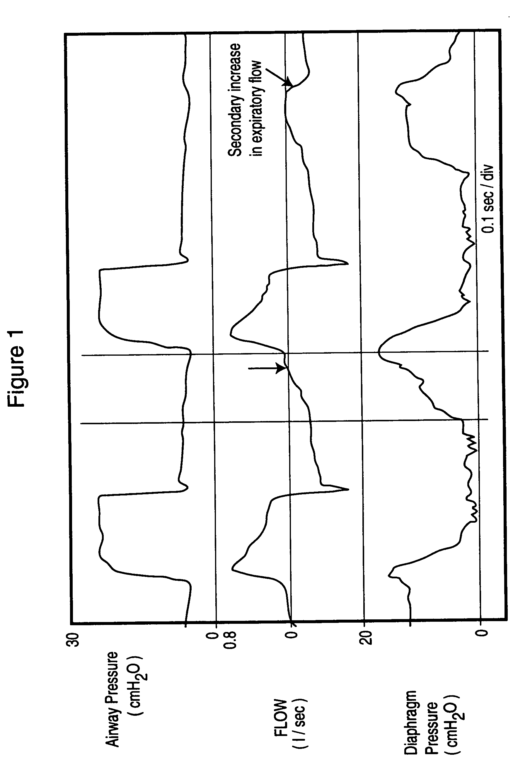 Method and device for monitoring and improving patient-ventilator interaction