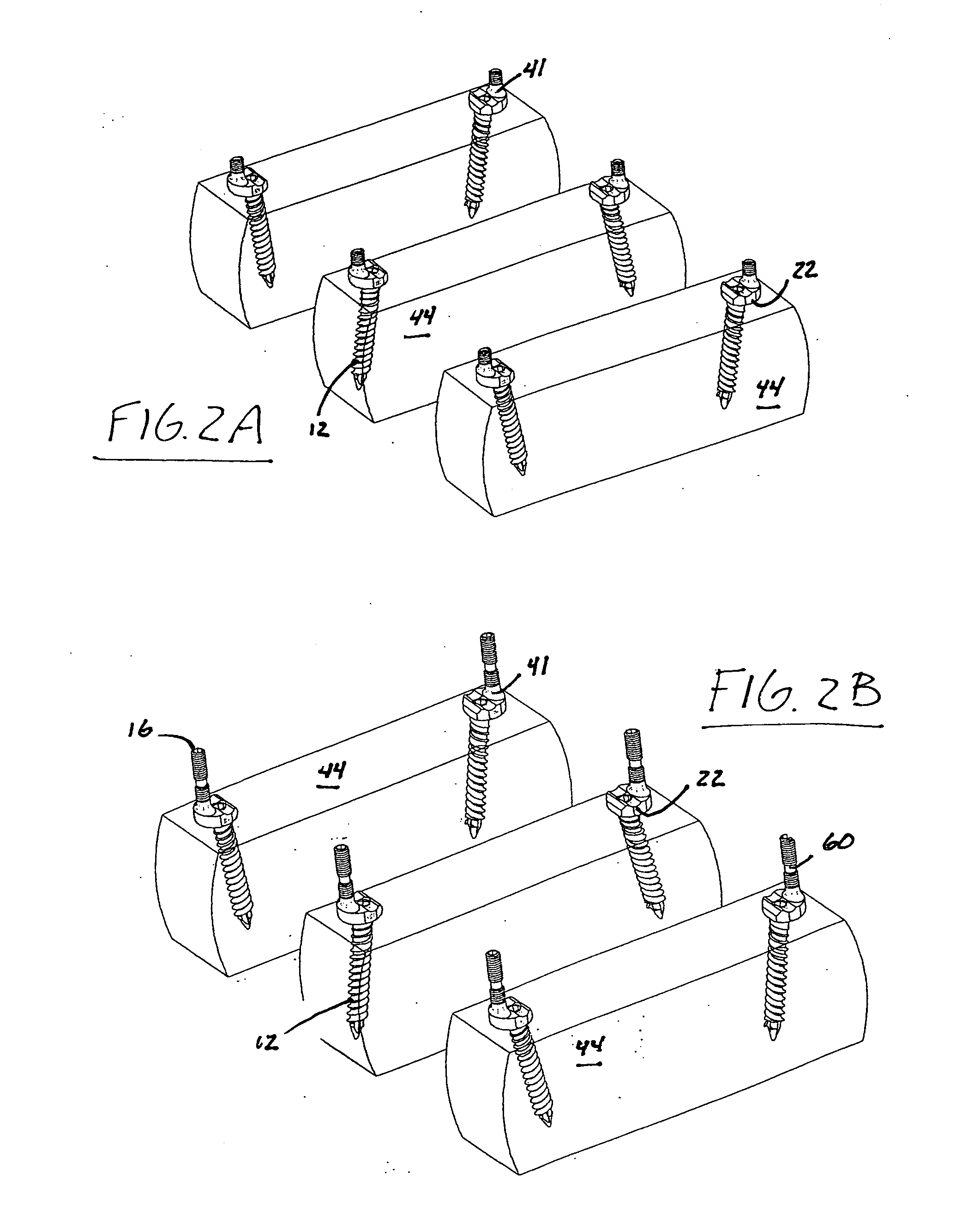 Rod and plate system for incremental reduction of the spine