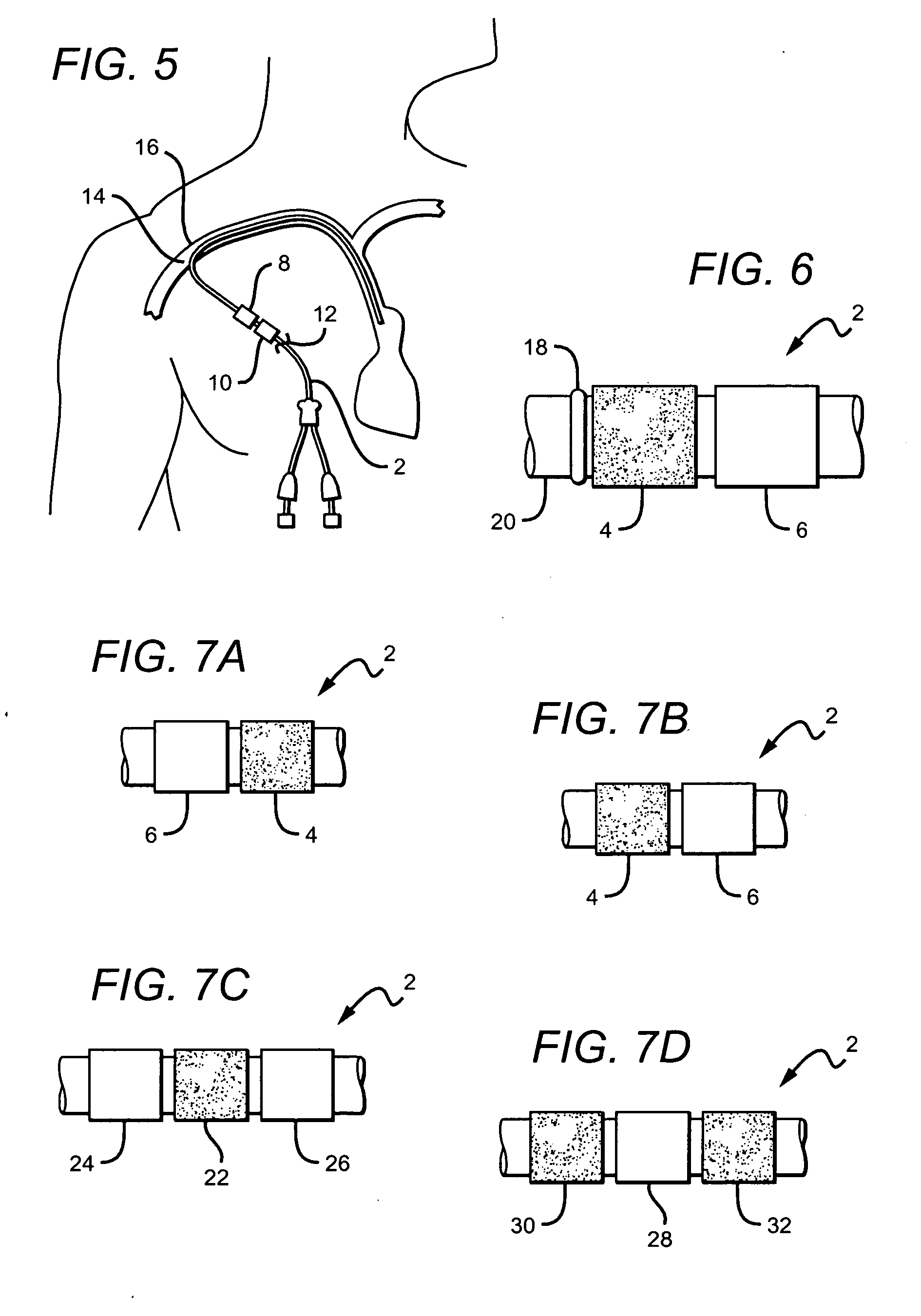 Hemostasis cuff for catheter securement