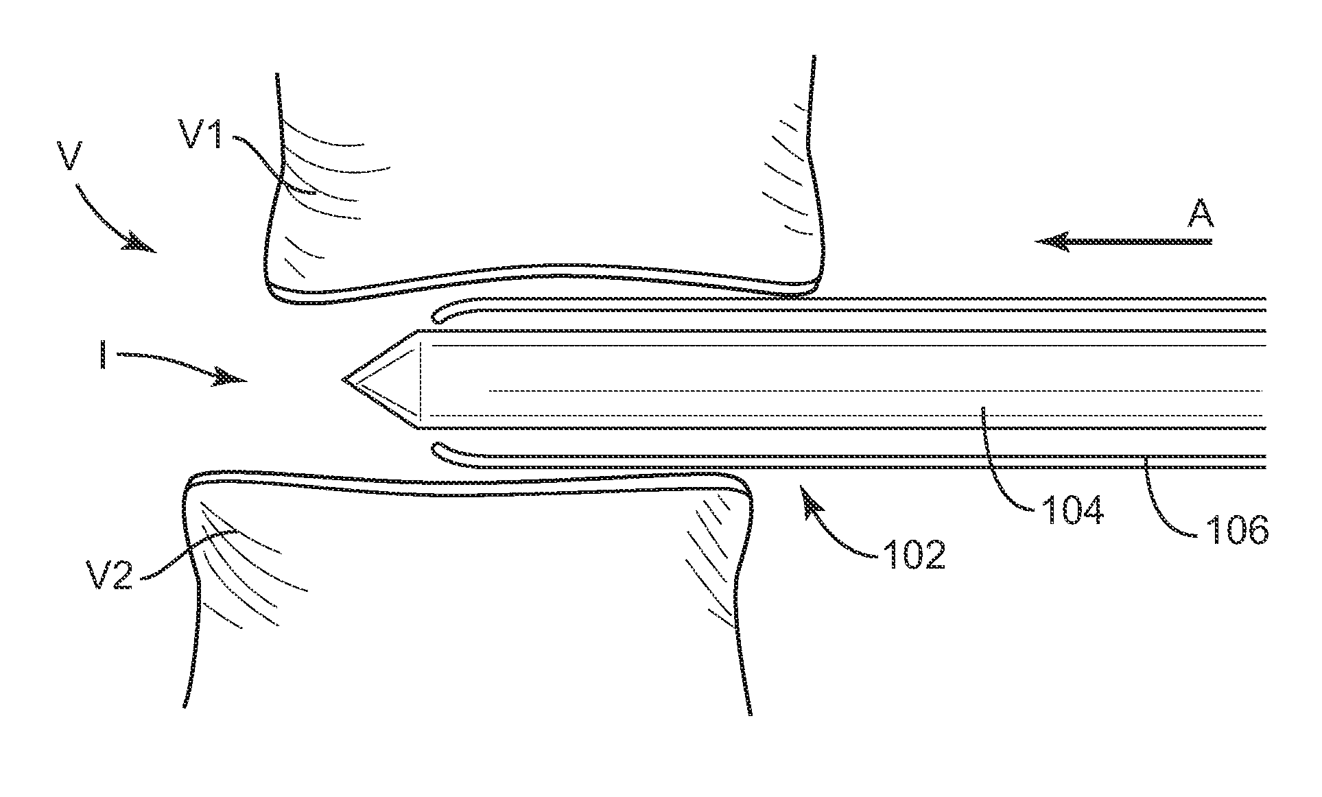 Expandable implant system and methods of use