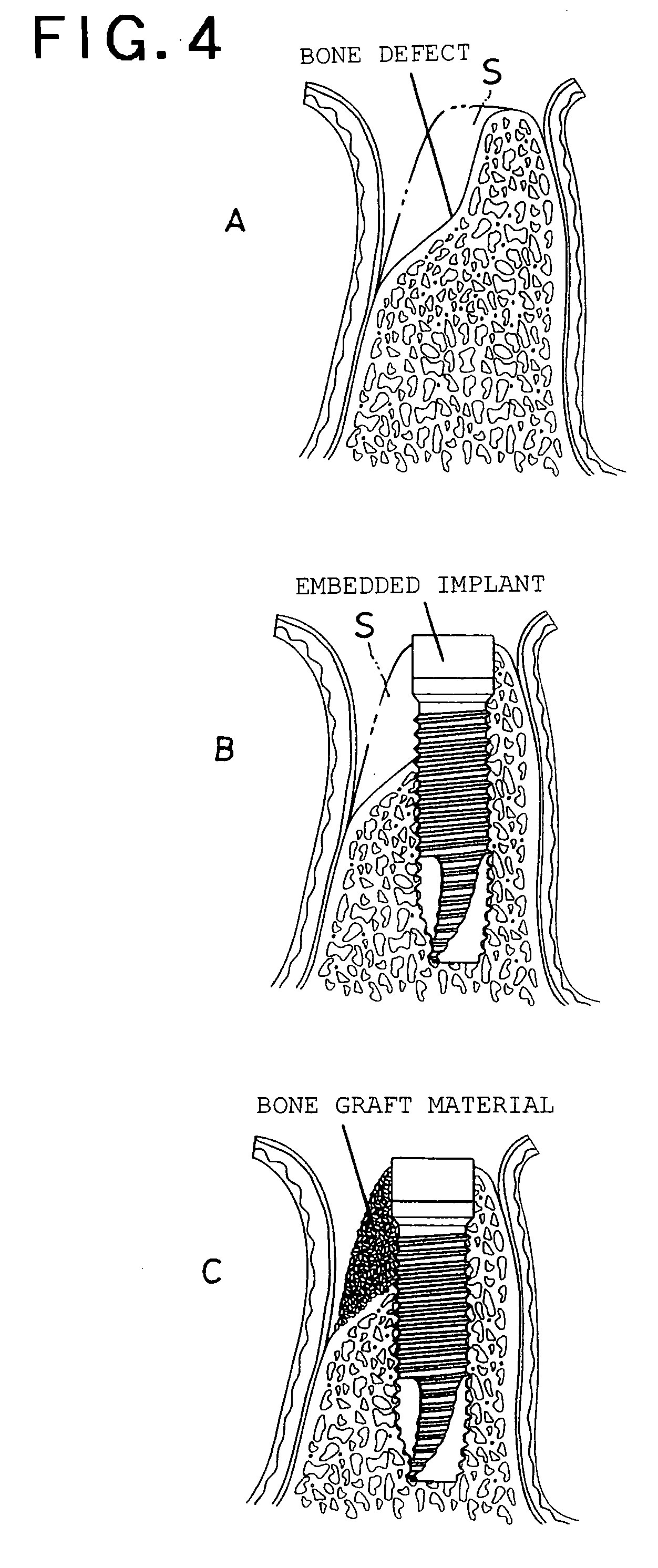 Dental Material And Composite Dental Material Formed By Using Hydroxy Apatite