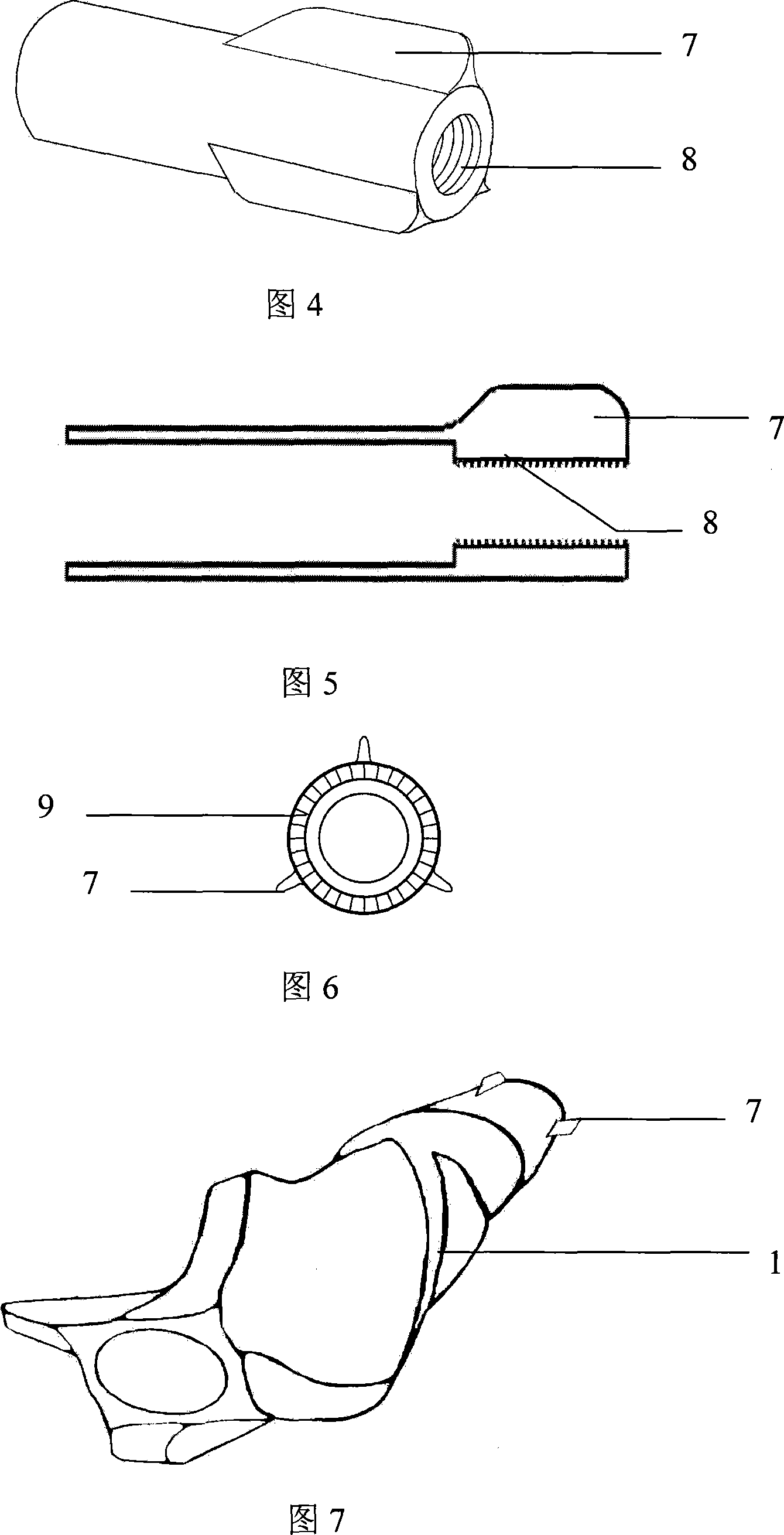 Anti-rotating self-locking bone fracture internal fixing device