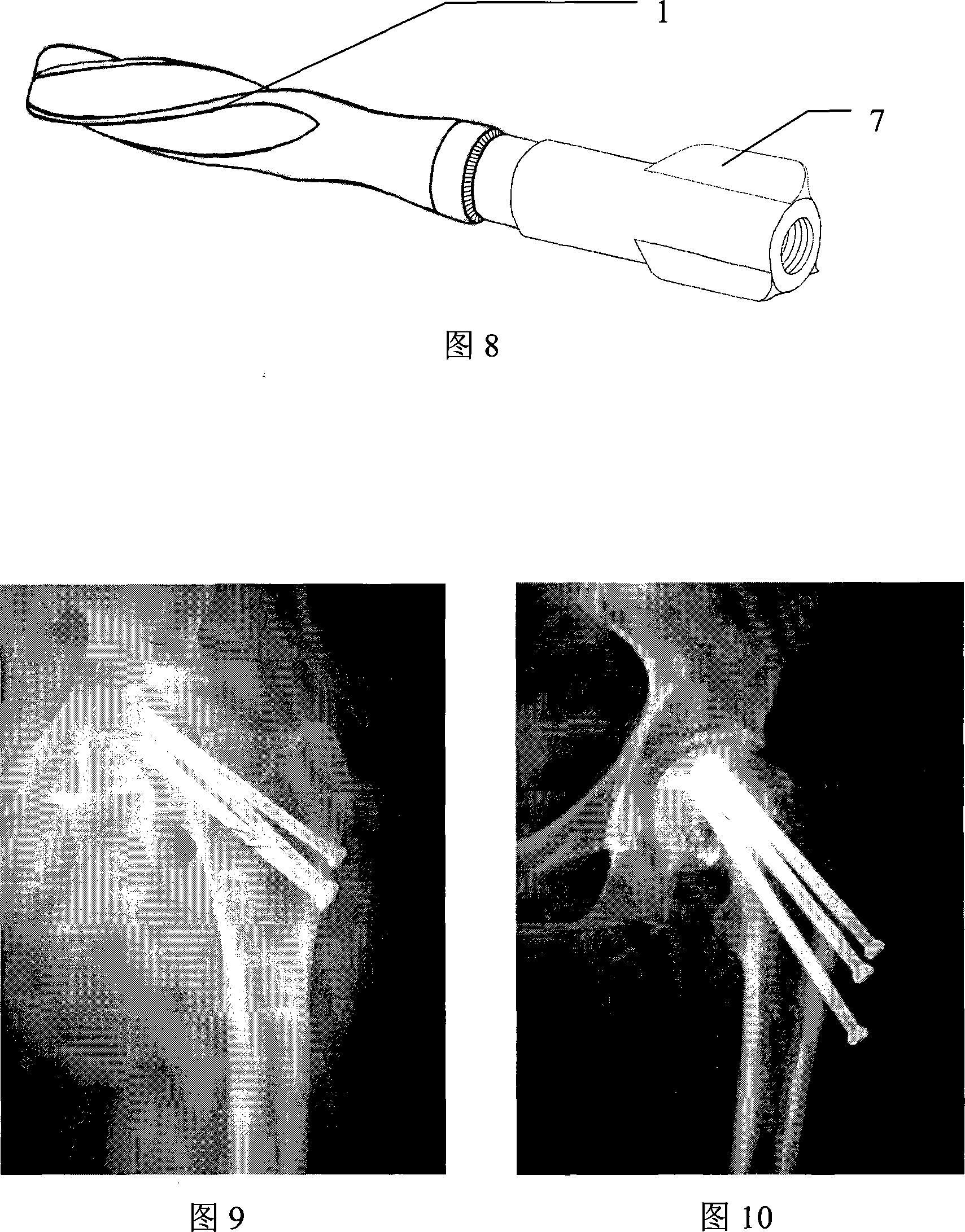 Anti-rotating self-locking bone fracture internal fixing device