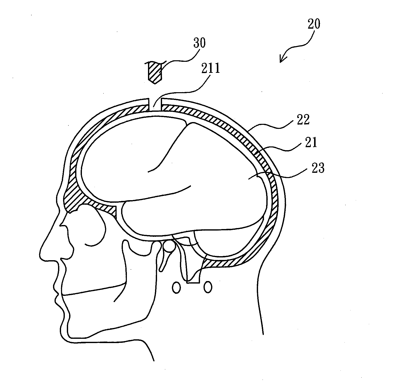 Skull endosseous module for ultrasound penetration