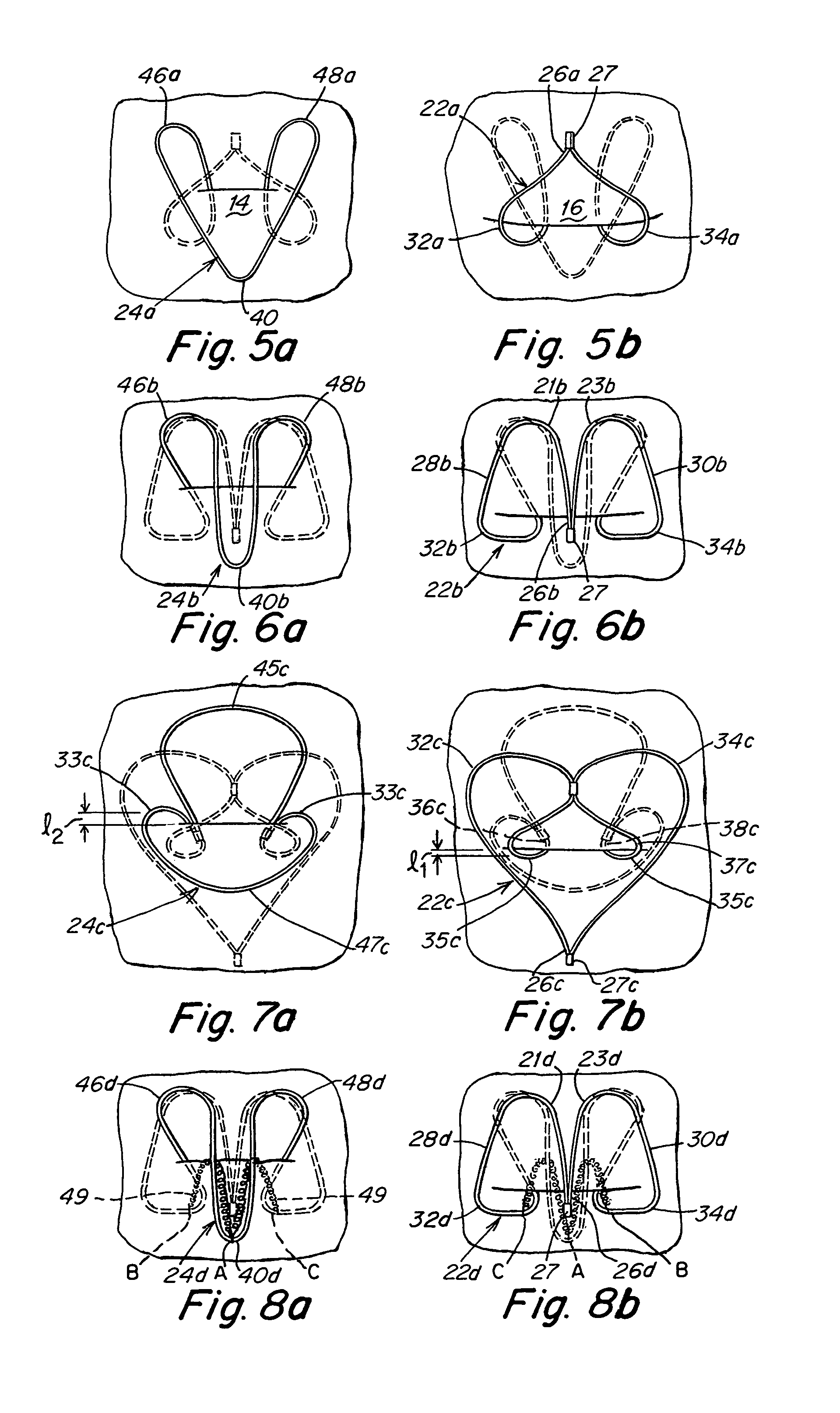 Patent foramen ovale (PFO) closure clips