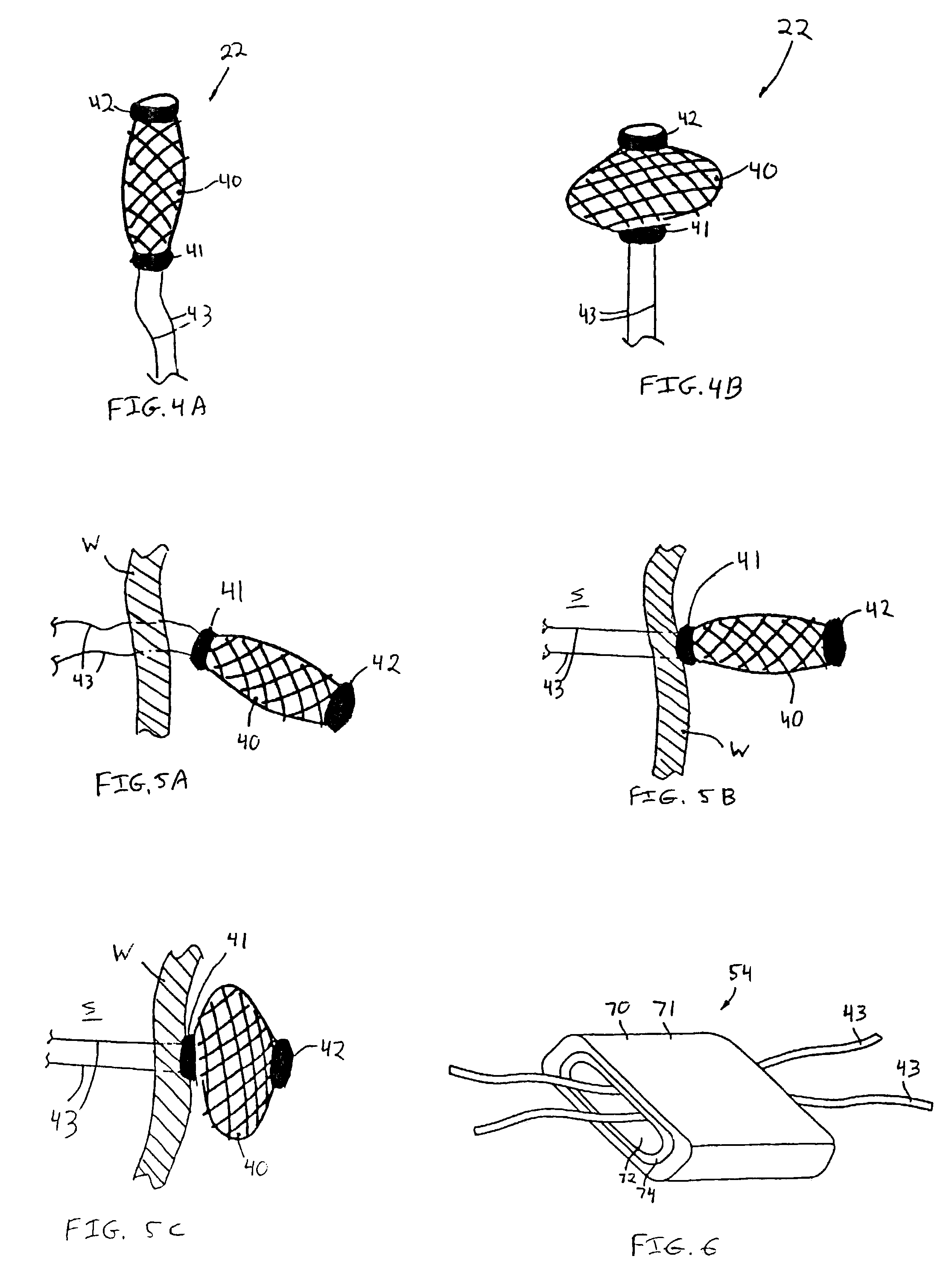 Methods for reduction of a gastric lumen