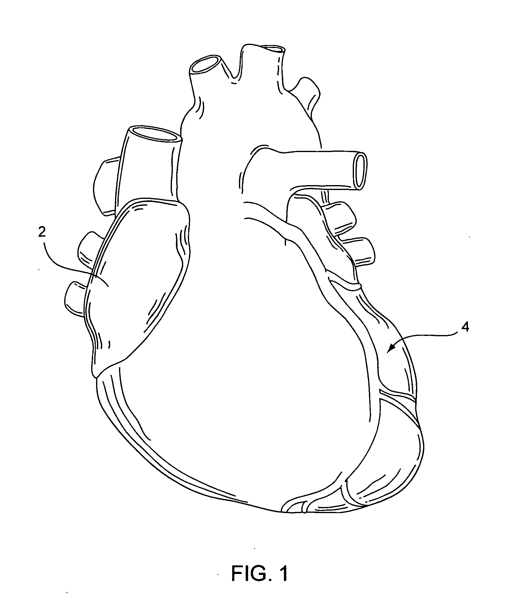 Stent delivery system