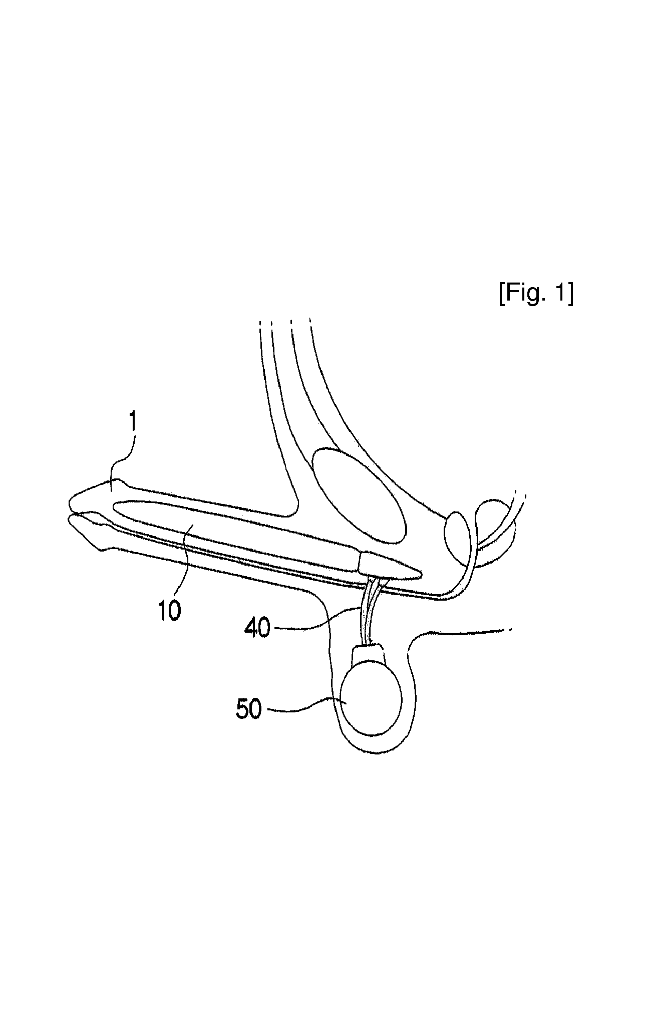 Inflatable prosthesis for aiding penile erection and augmentation