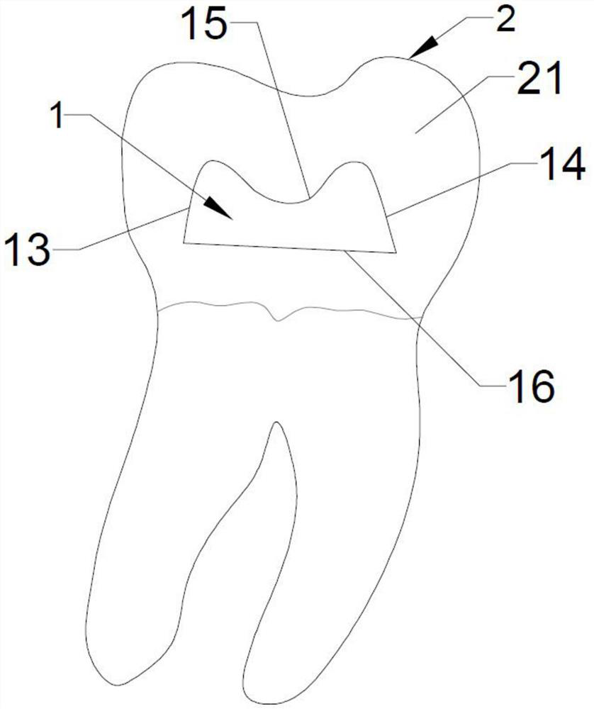 Invisible orthodontic bimodal accessory