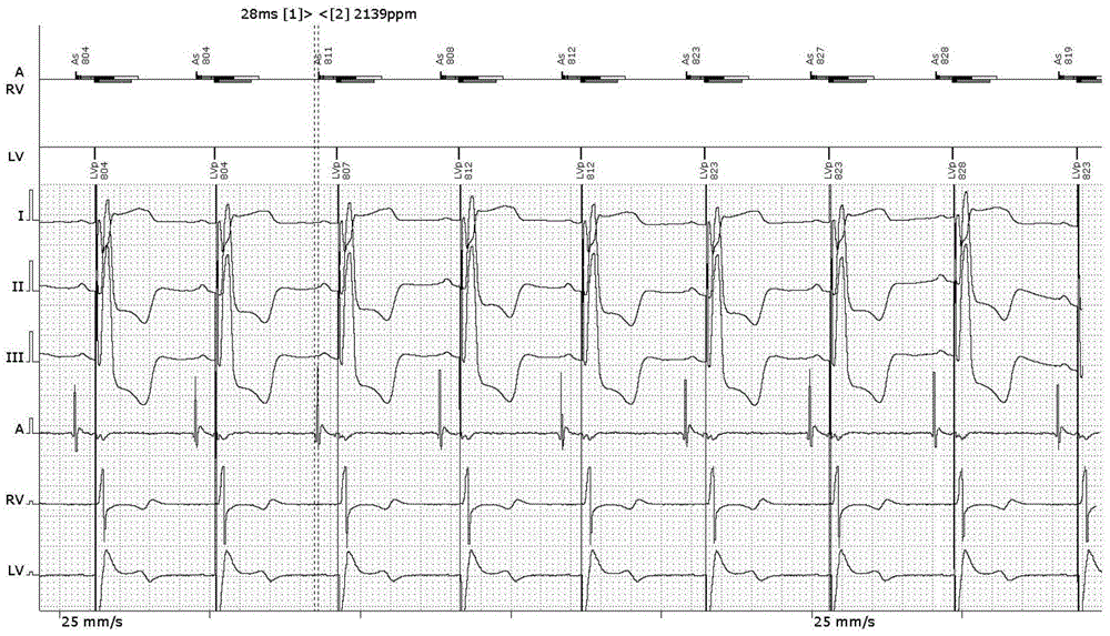 System for achieving double-ventricle re-synchronization via single left ventricle hop-by-hop tracking biological atrioventricular delay