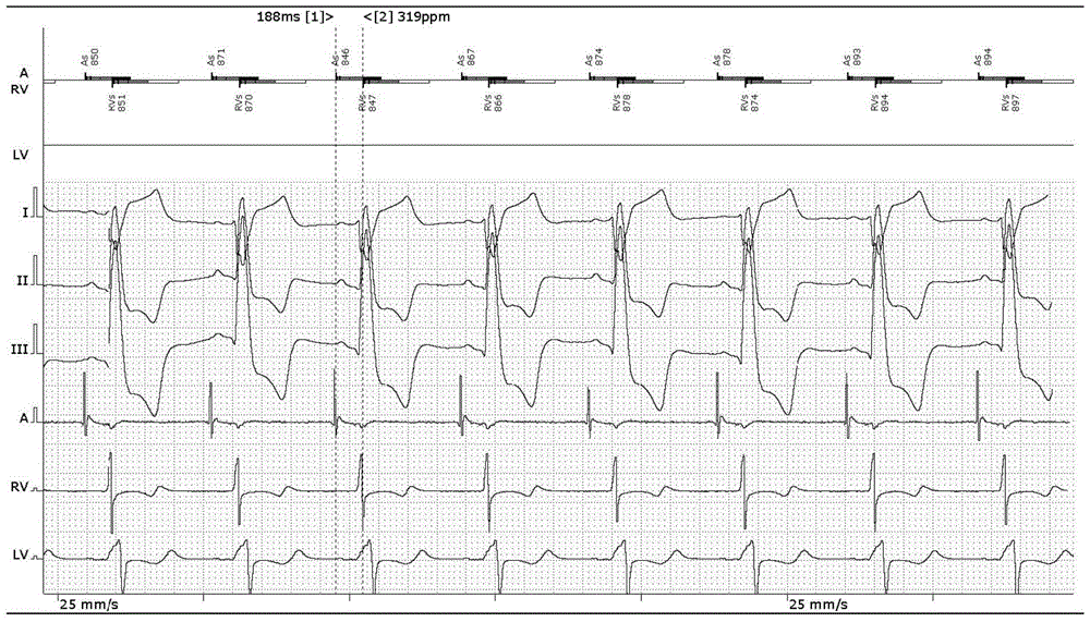 System for achieving double-ventricle re-synchronization via single left ventricle hop-by-hop tracking biological atrioventricular delay