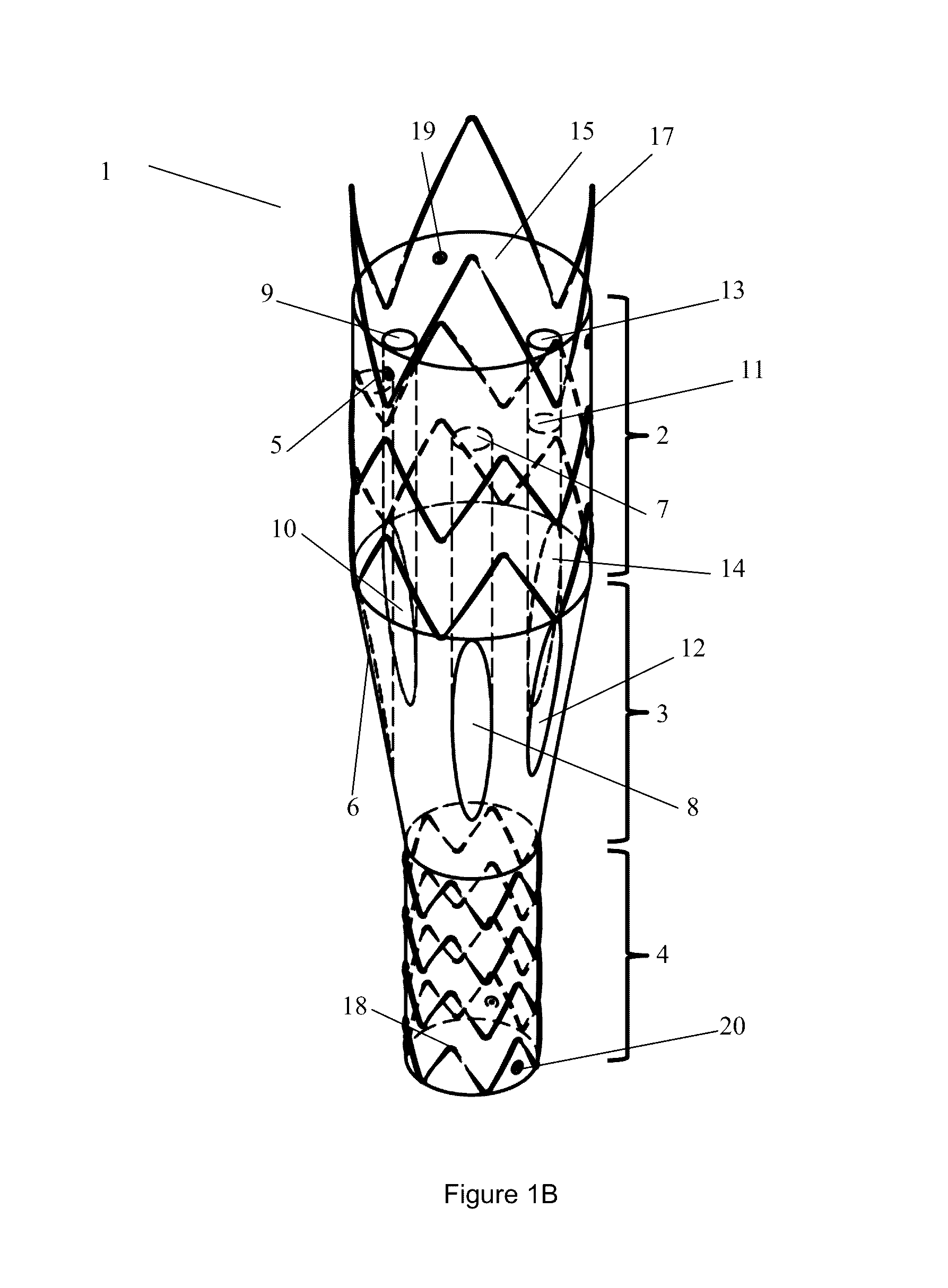 Endoprosthesis for endovascular treatment of thoracic-abdominal aortic aneurysms or dissections and endoprosthesis for endovascular treatment of abdominal aortic aneurysms or dissections which compromise the iliac arteries