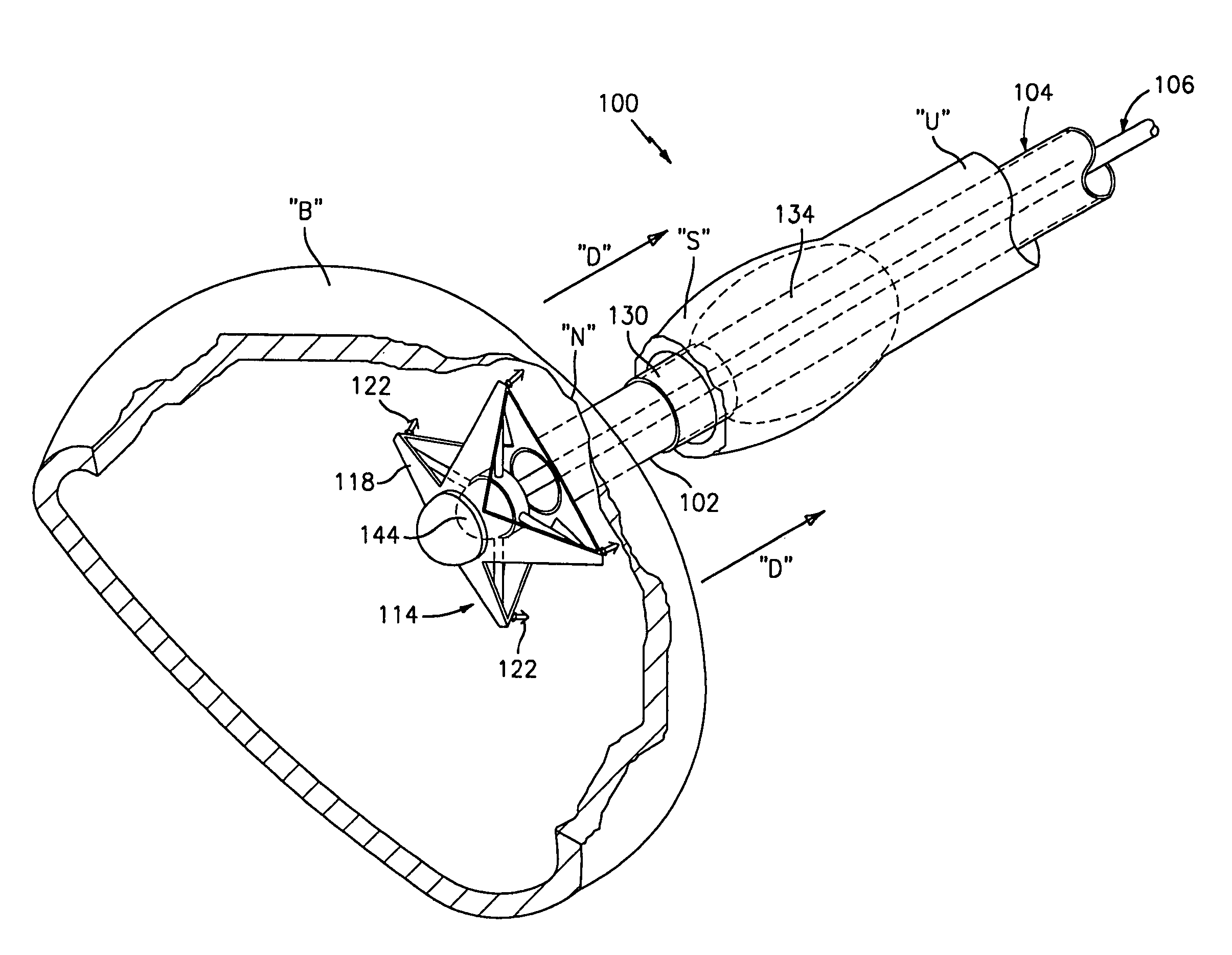 Method and apparatus for anastomosis including an anchoring sleeve