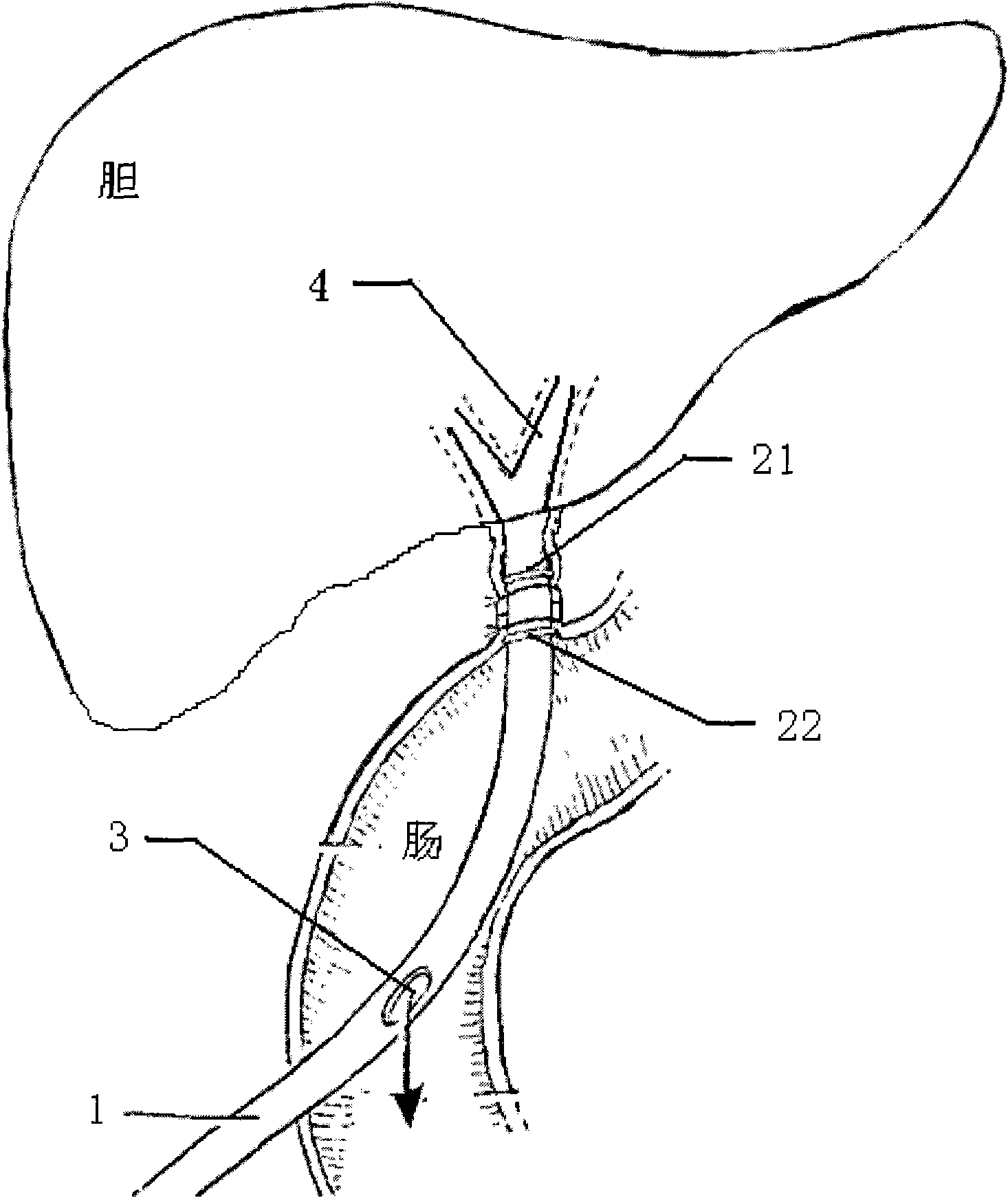 Biliary-enteric anastomosis support tube