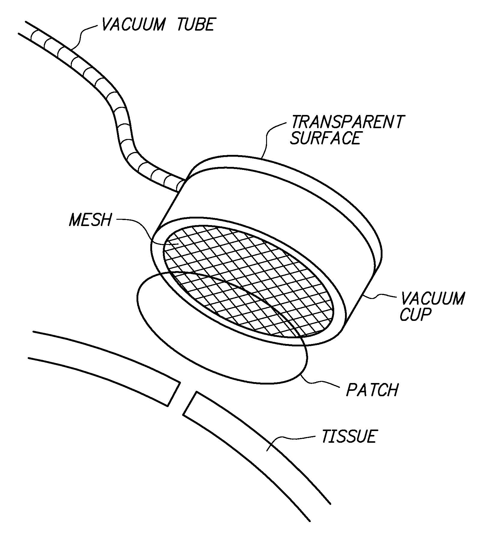 Sutureless methods for laceration closure