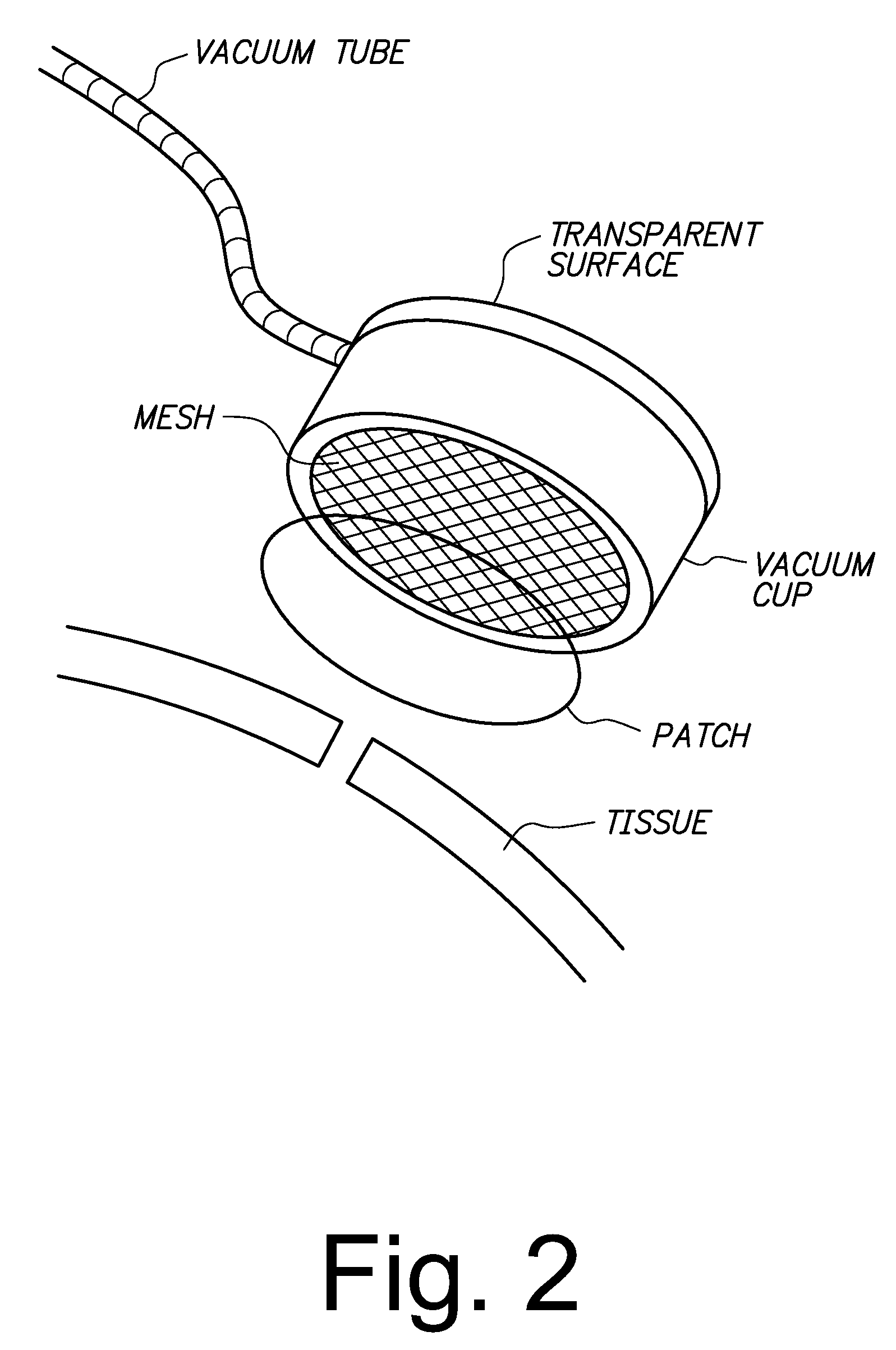 Sutureless methods for laceration closure