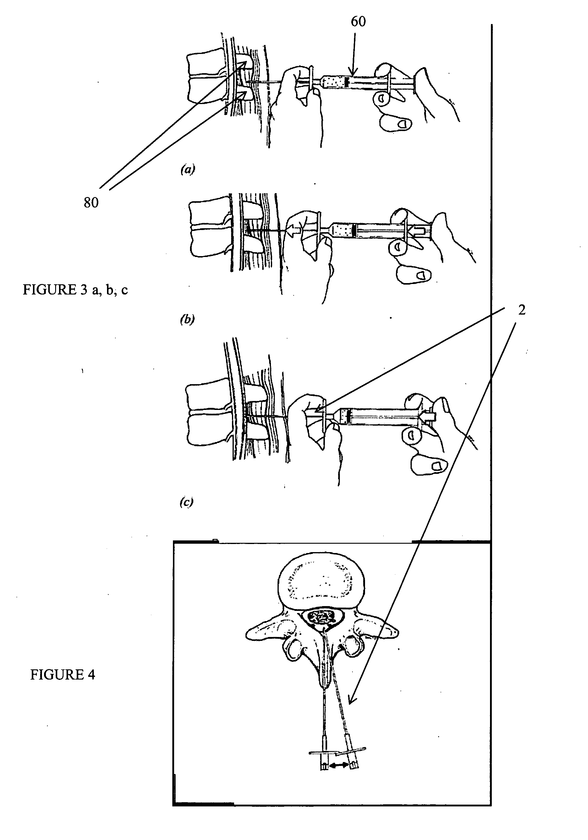 Devices and methods for tissue modification