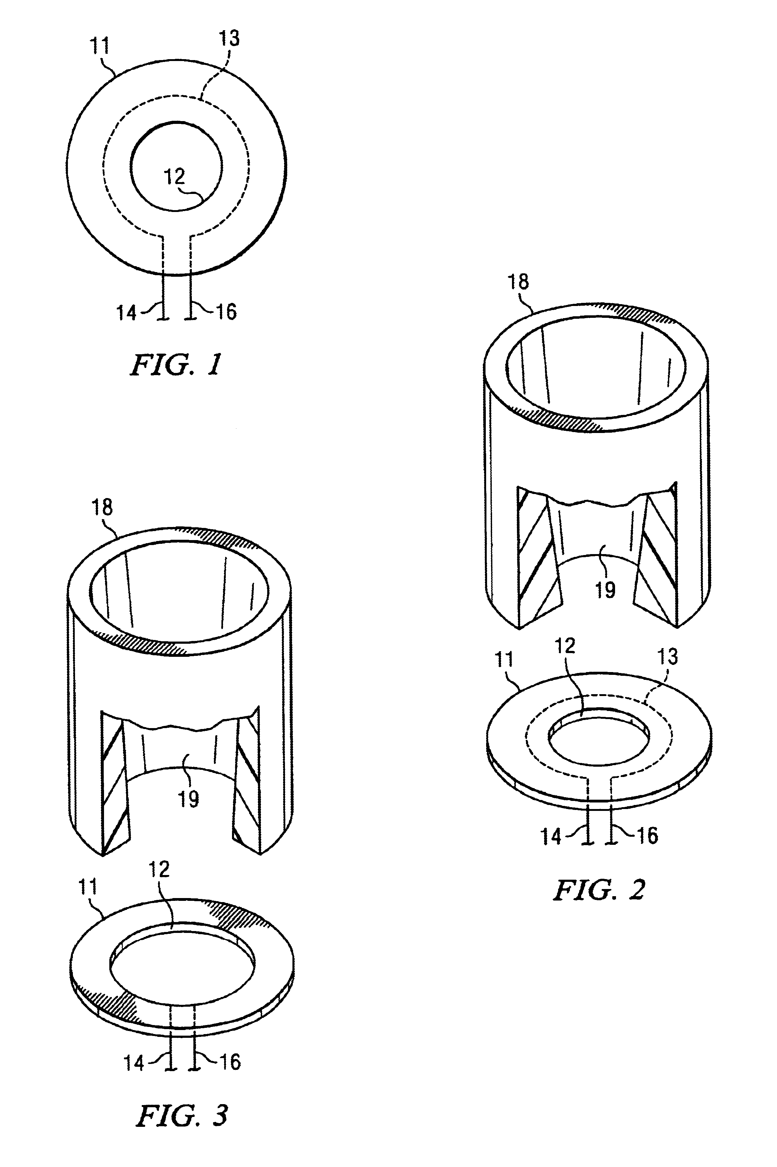 Hydrocyclone wear-detection sensor