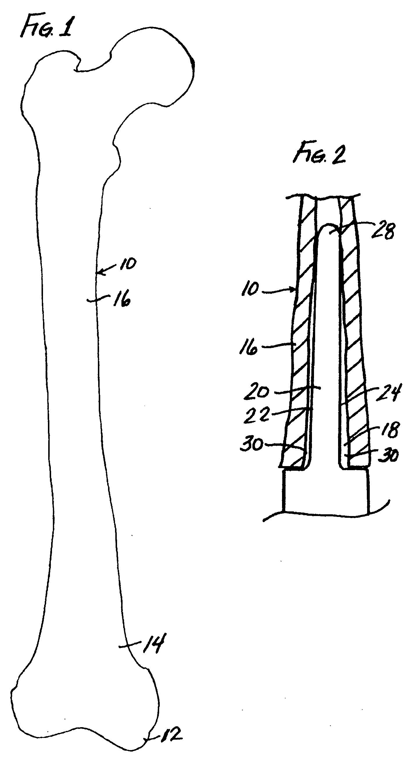 Modular implant system and method with diaphyseal implant and adapter